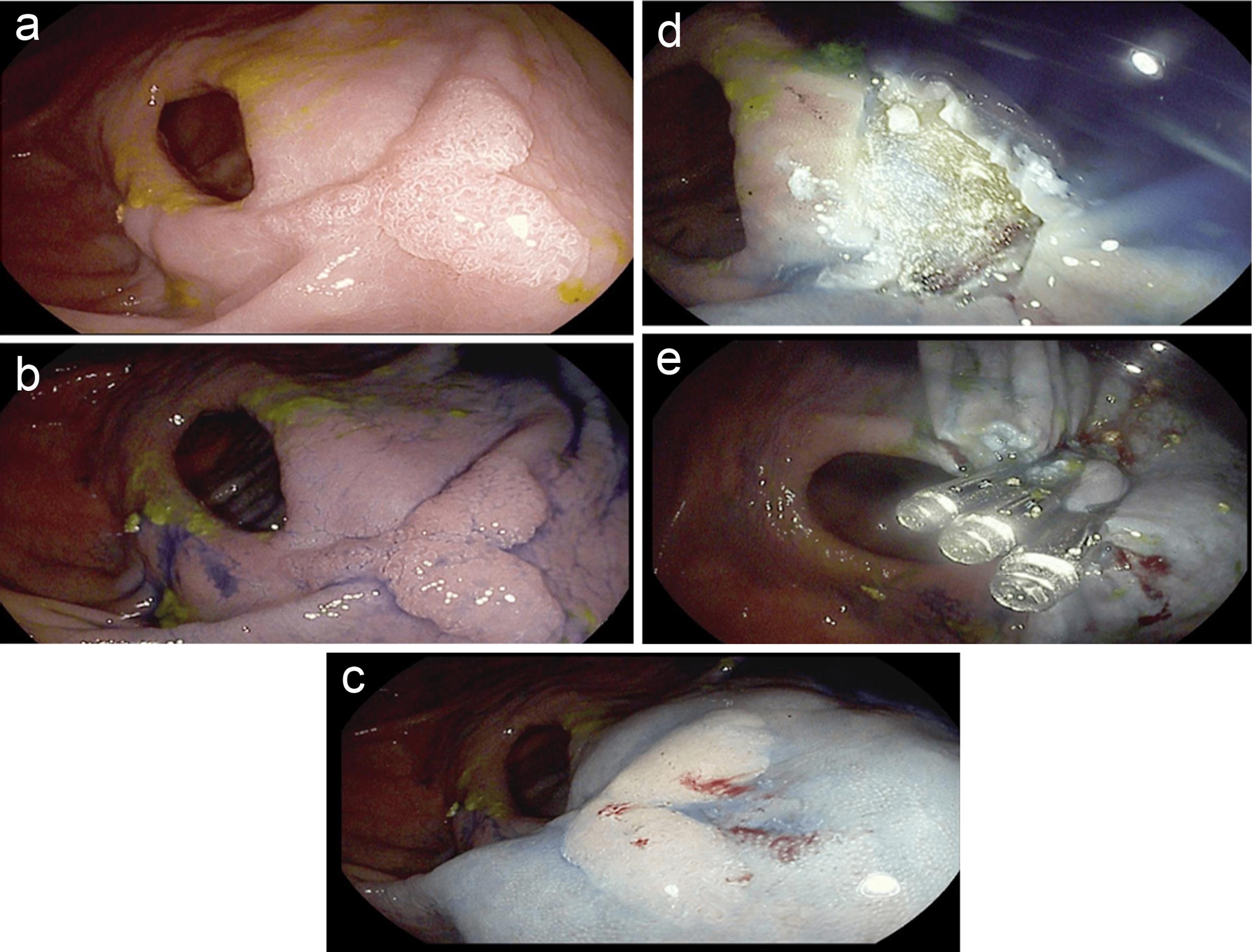 Lateral spreading tumor (LST) with low grade dysplasia resected with “en bloc” EMR in a patient with longstanding CD with ileocecal resection and left hemicolectomy for adenocarcinoma.