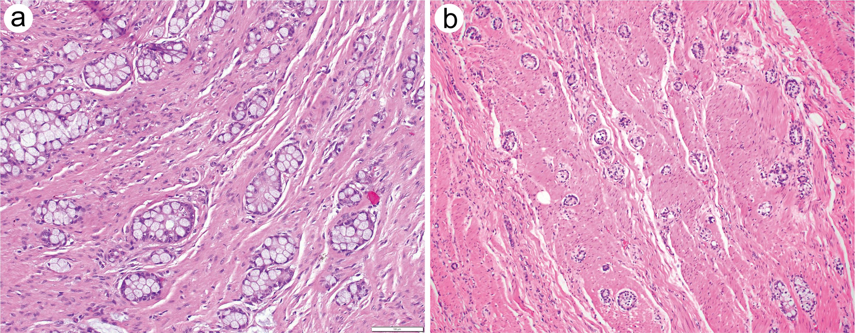 goblet-cell-adenocarcinoma-of-the-appendix-diagnosis-prognosis-and