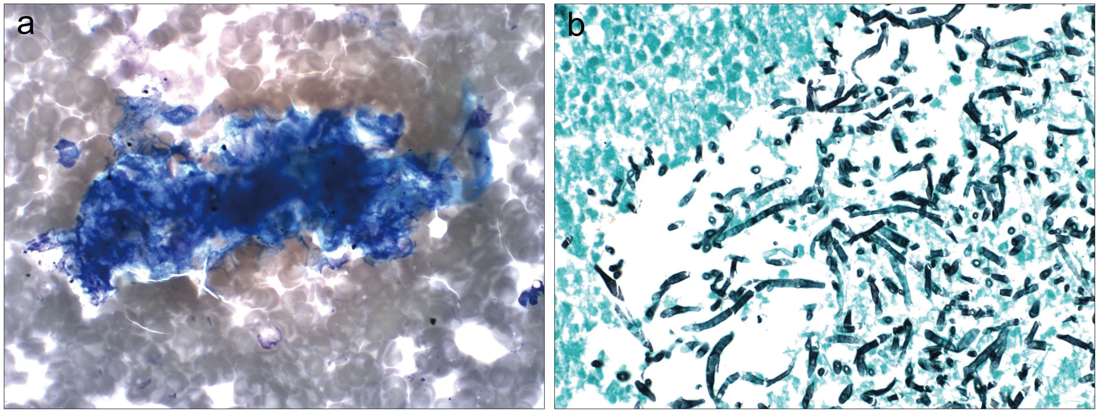 Aspergilloma.