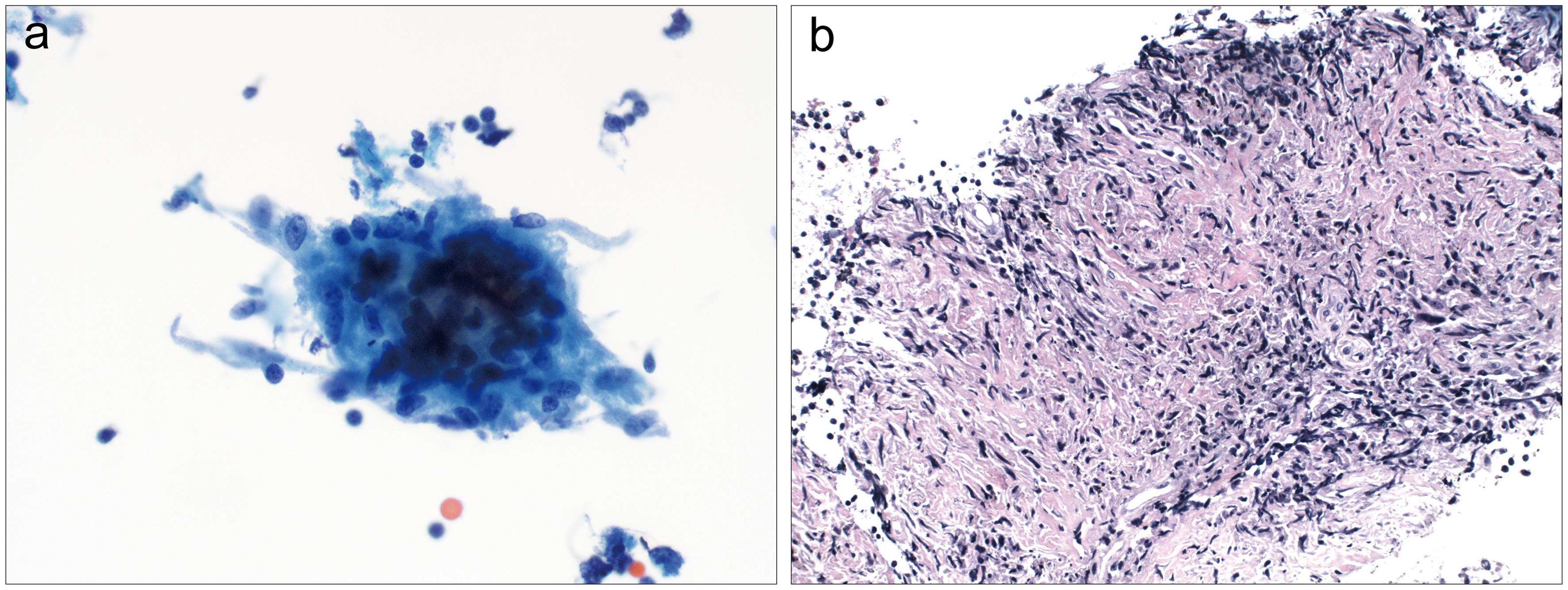 Sarcoidosis.