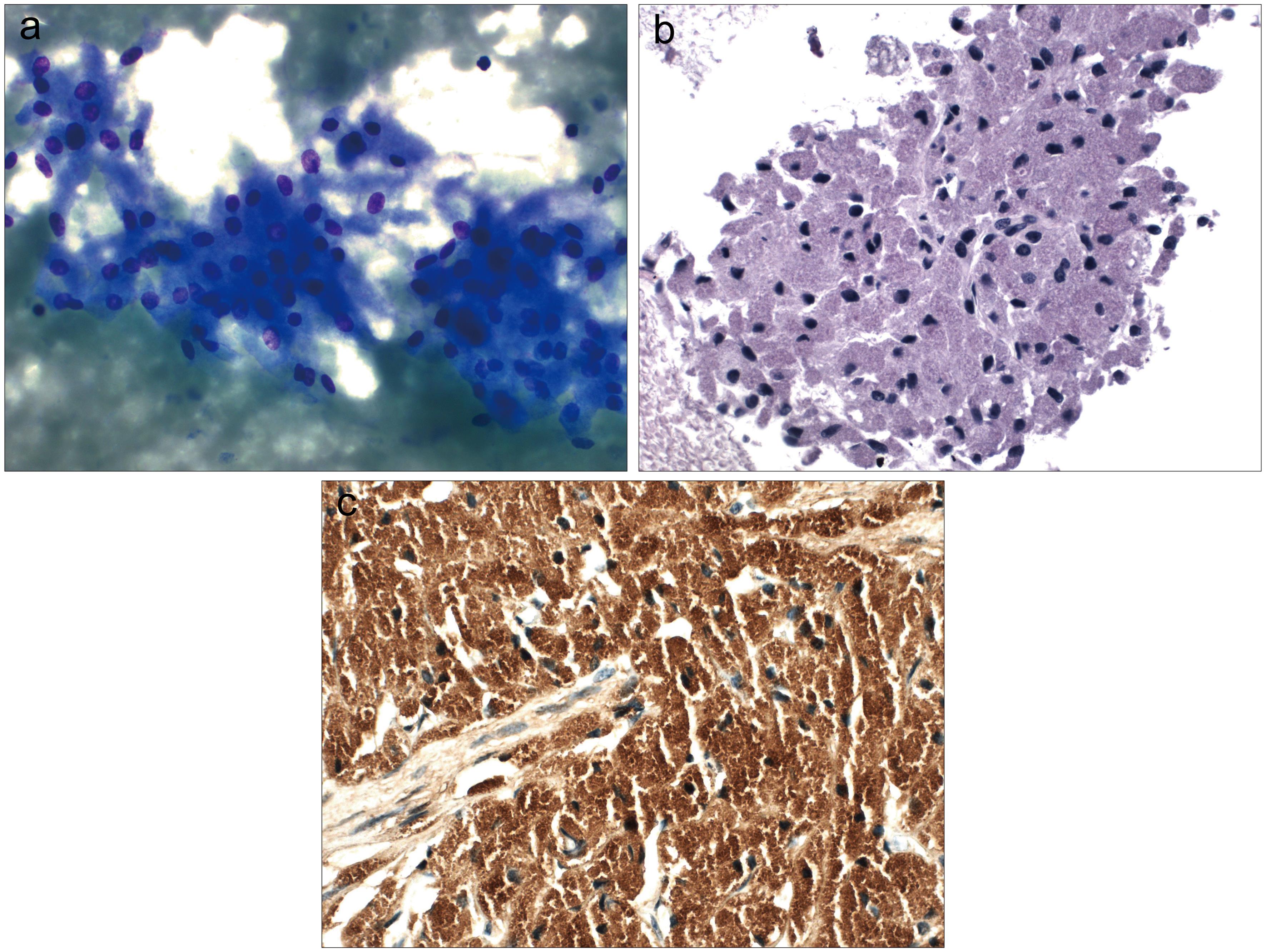 Granular cell tumor.