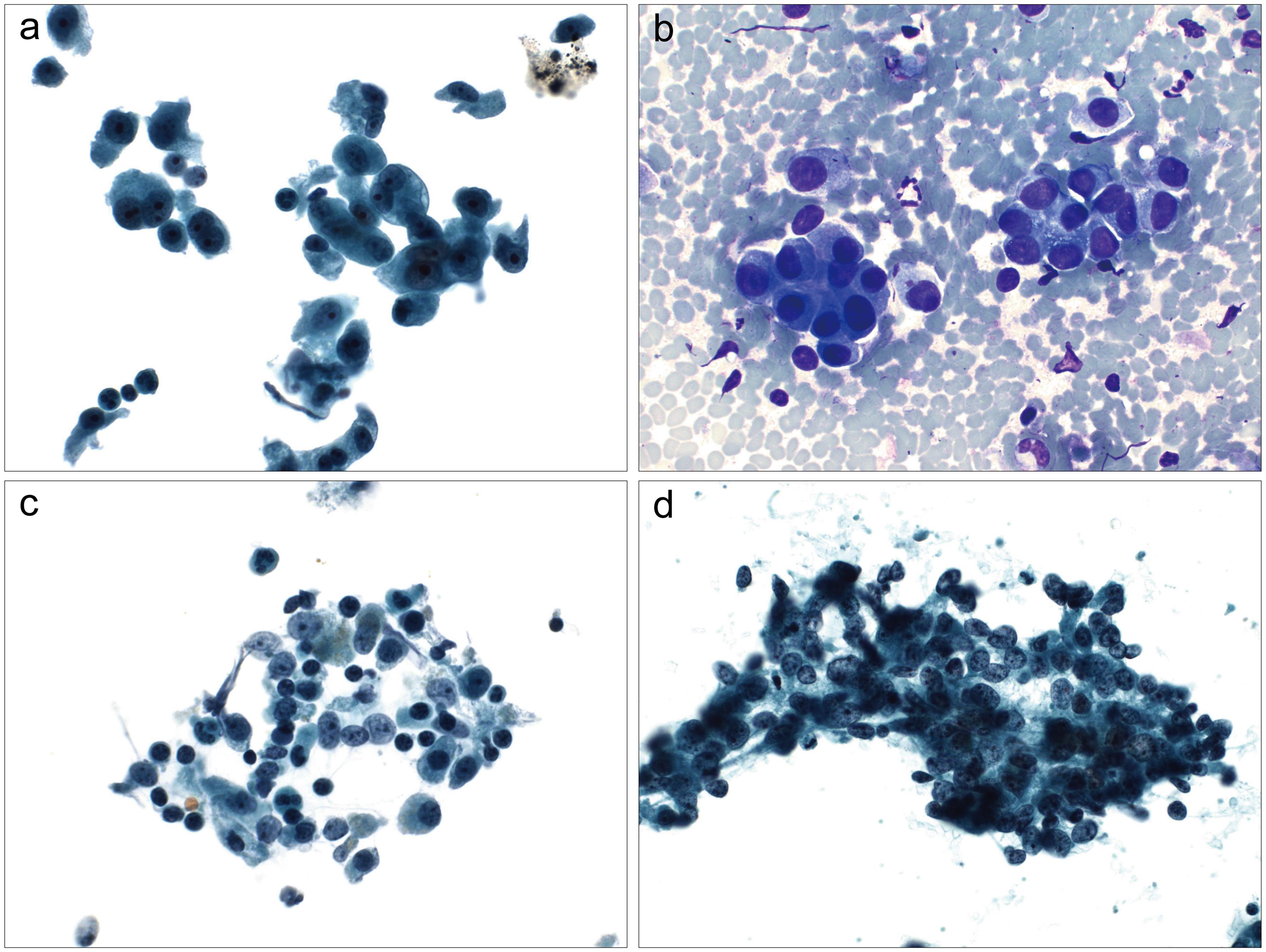 Adenocarcinoma.