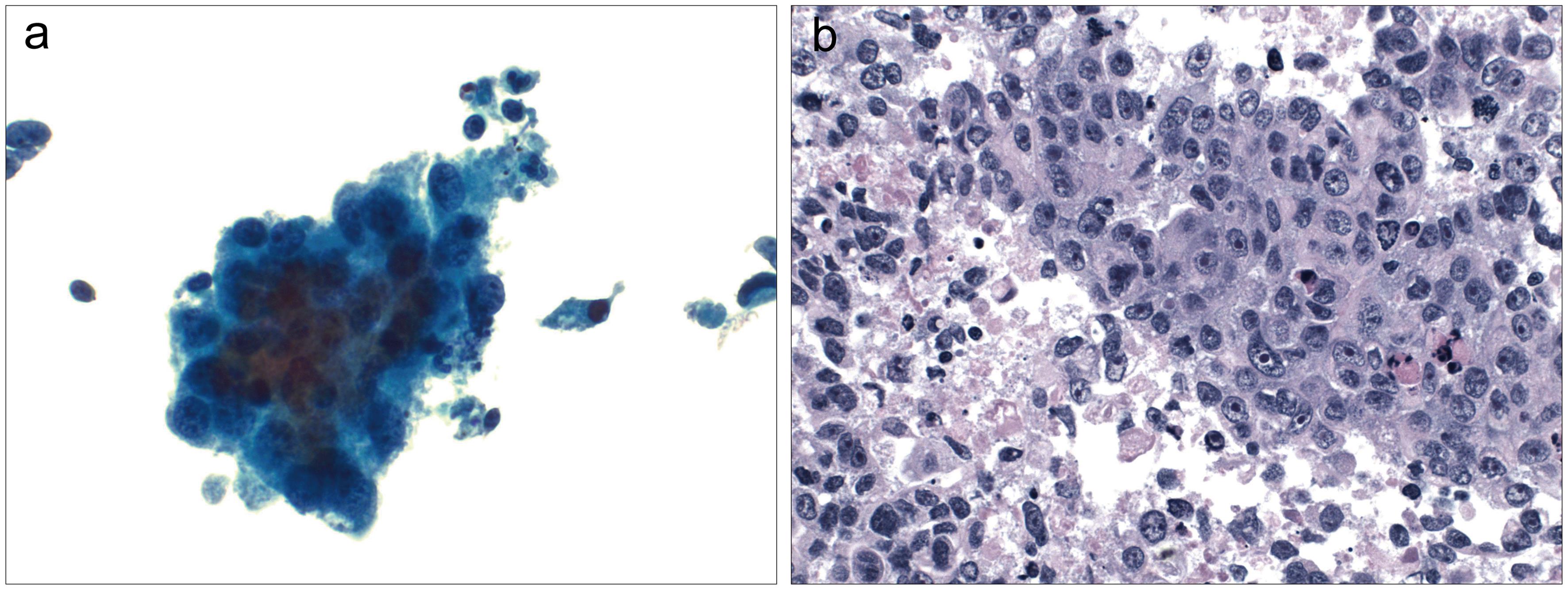 Squamous cell carcinoma.