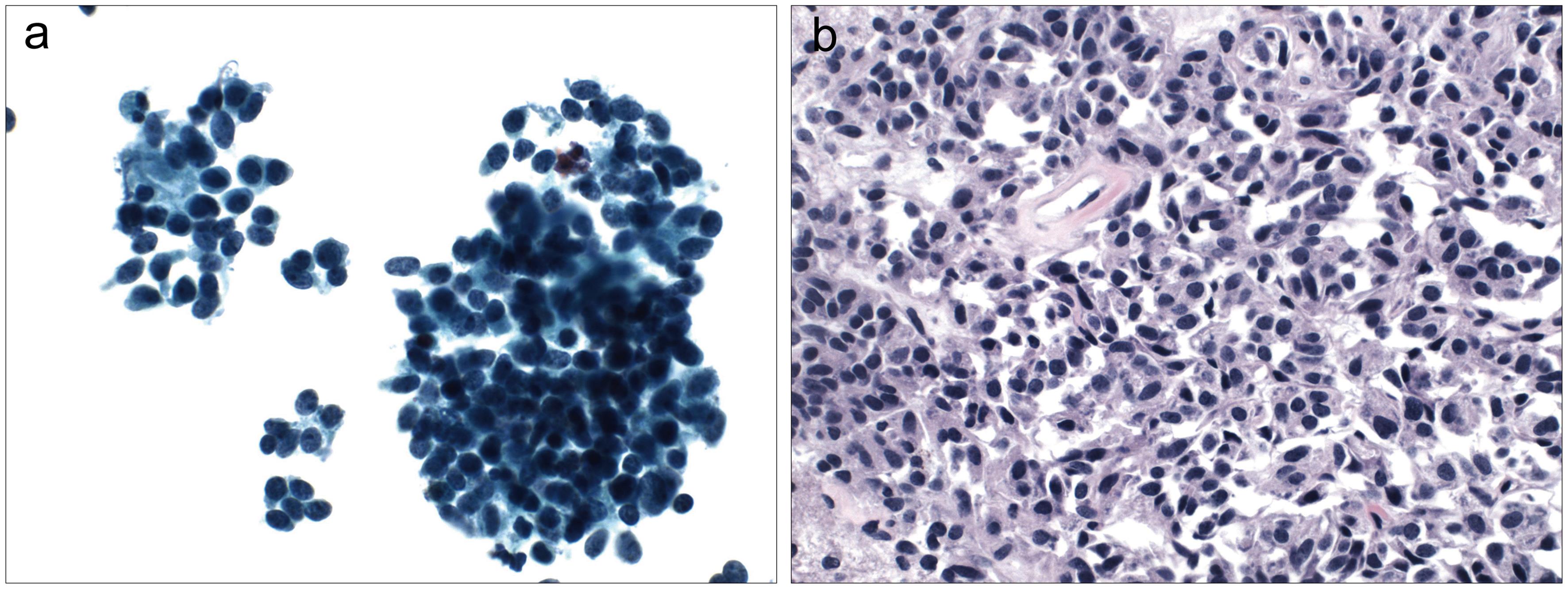 Carcinoid/neuroendocrine tumors.