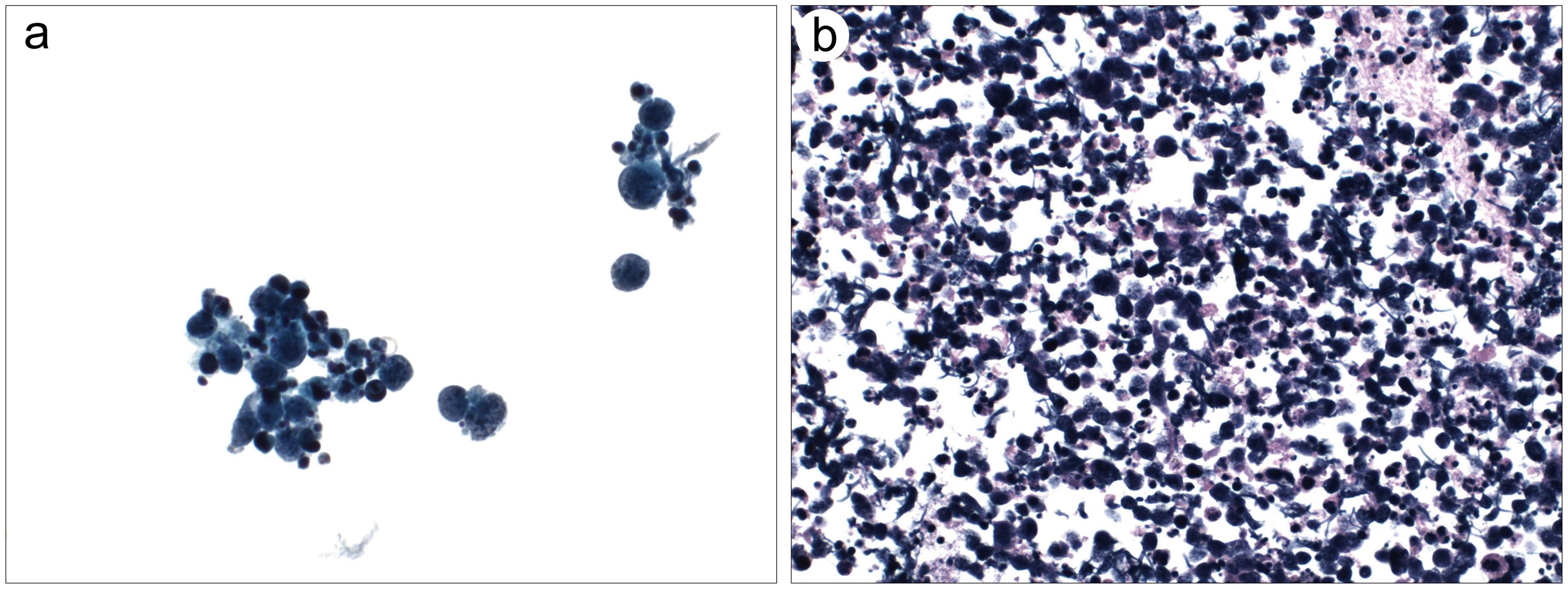 Small cell carcinoma.