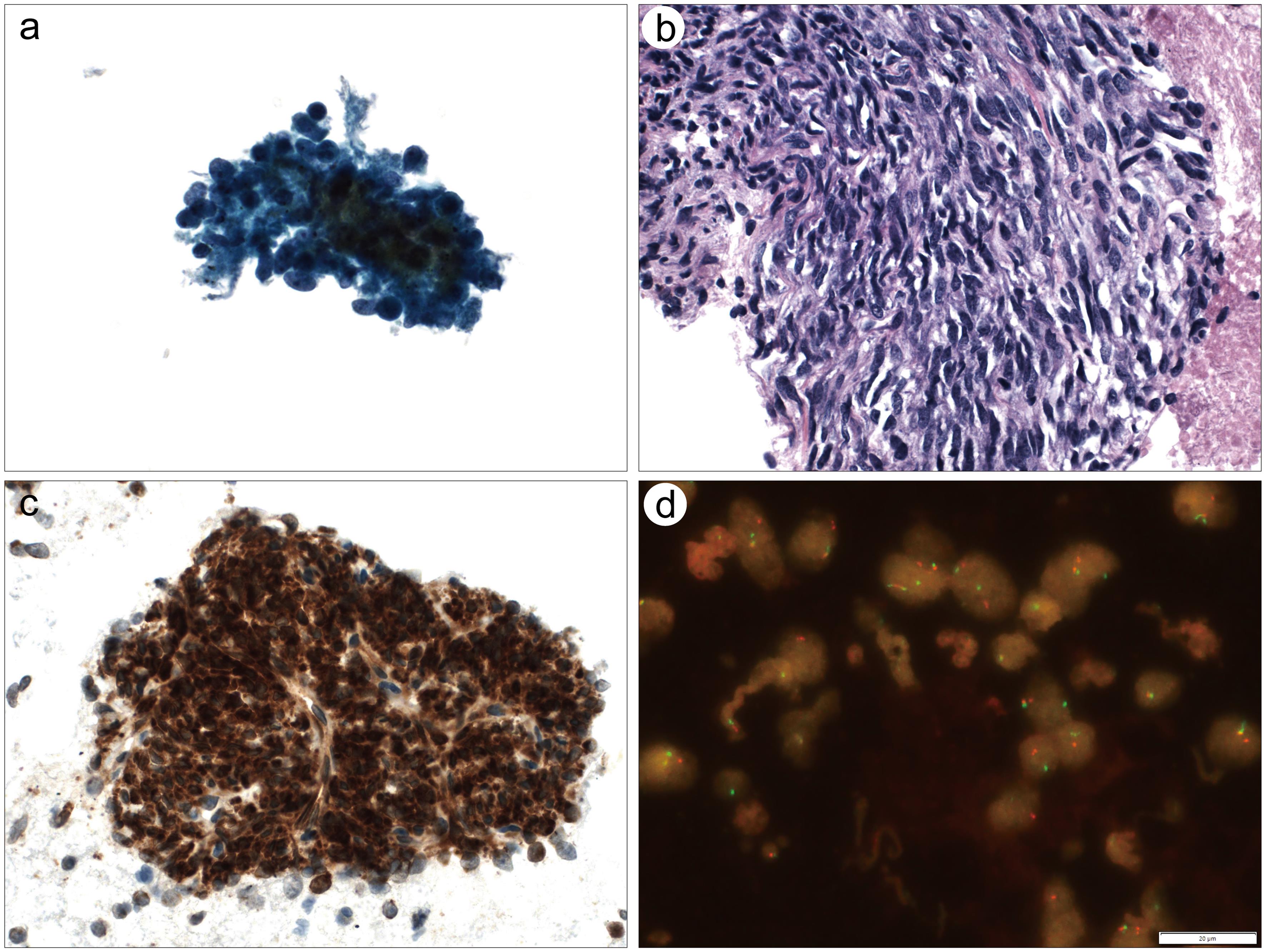 Synovial sarcoma.