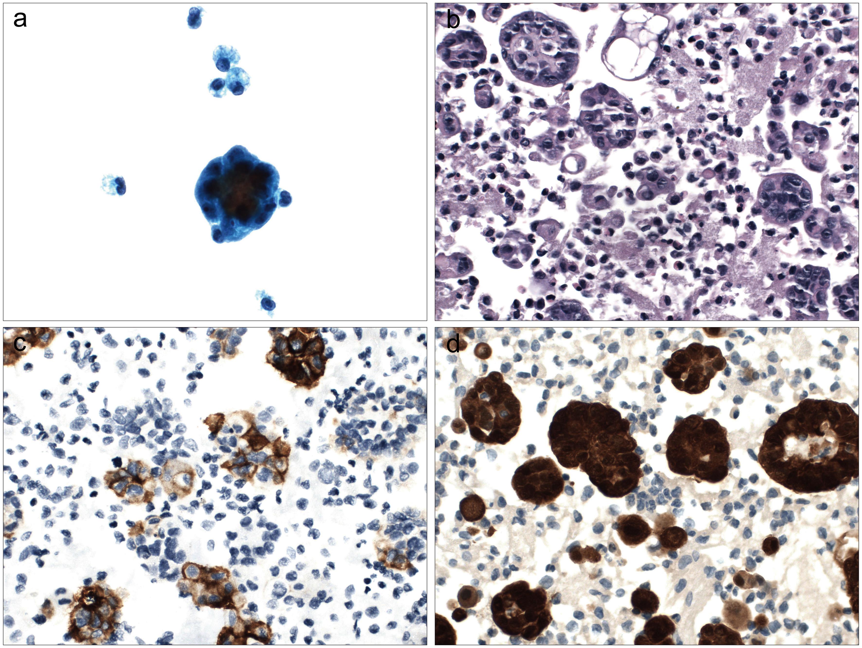 Malignant mesothelioma, epithelioid subtype.