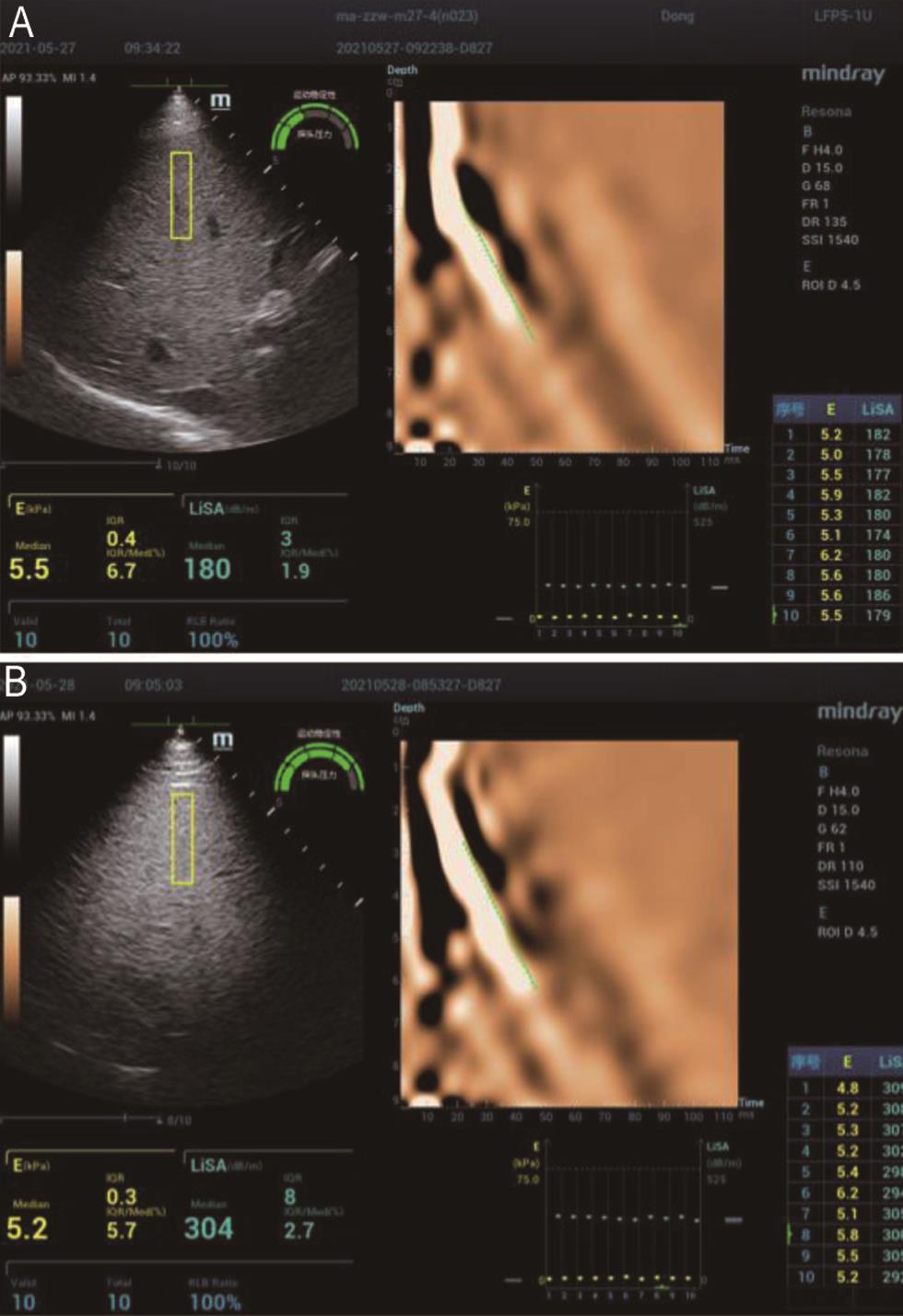 Representative liver ultrasound attenuation (LiSA) measurements of a patient (A) without fatty liver and a patient (B) with fatty liver.