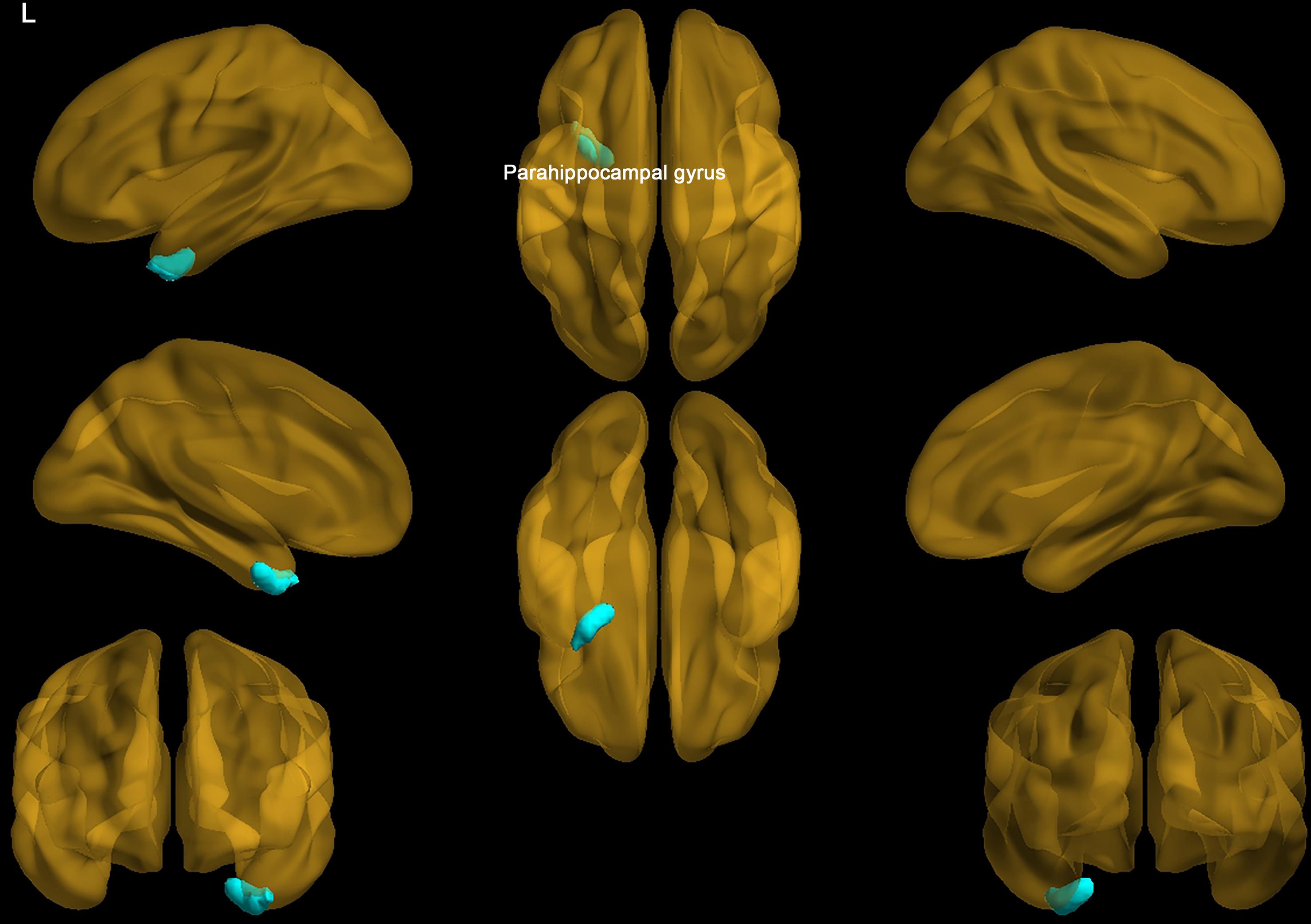 In the delirium group, the FC between the brainstem ARAS nuclei and the left parahippocampal gyrus is disrupted compared to the non-delirium group.