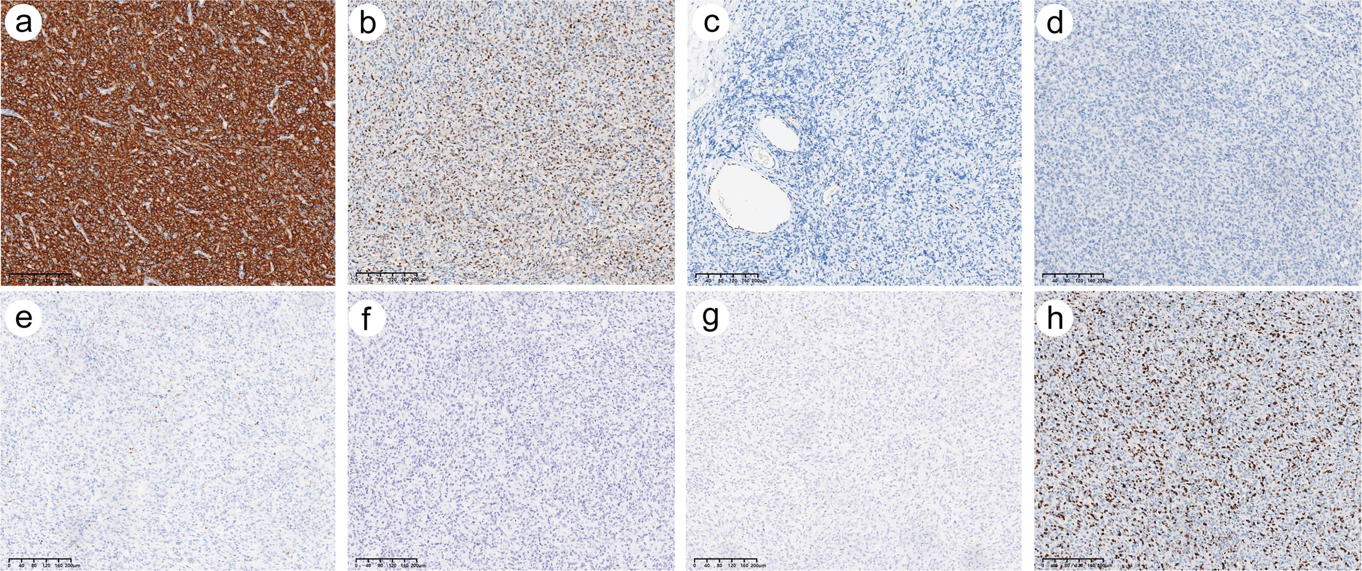 Representative immunohistochemical stains of the axillary mass tissue (original magnification, ×100; scale bar, 40 µm).