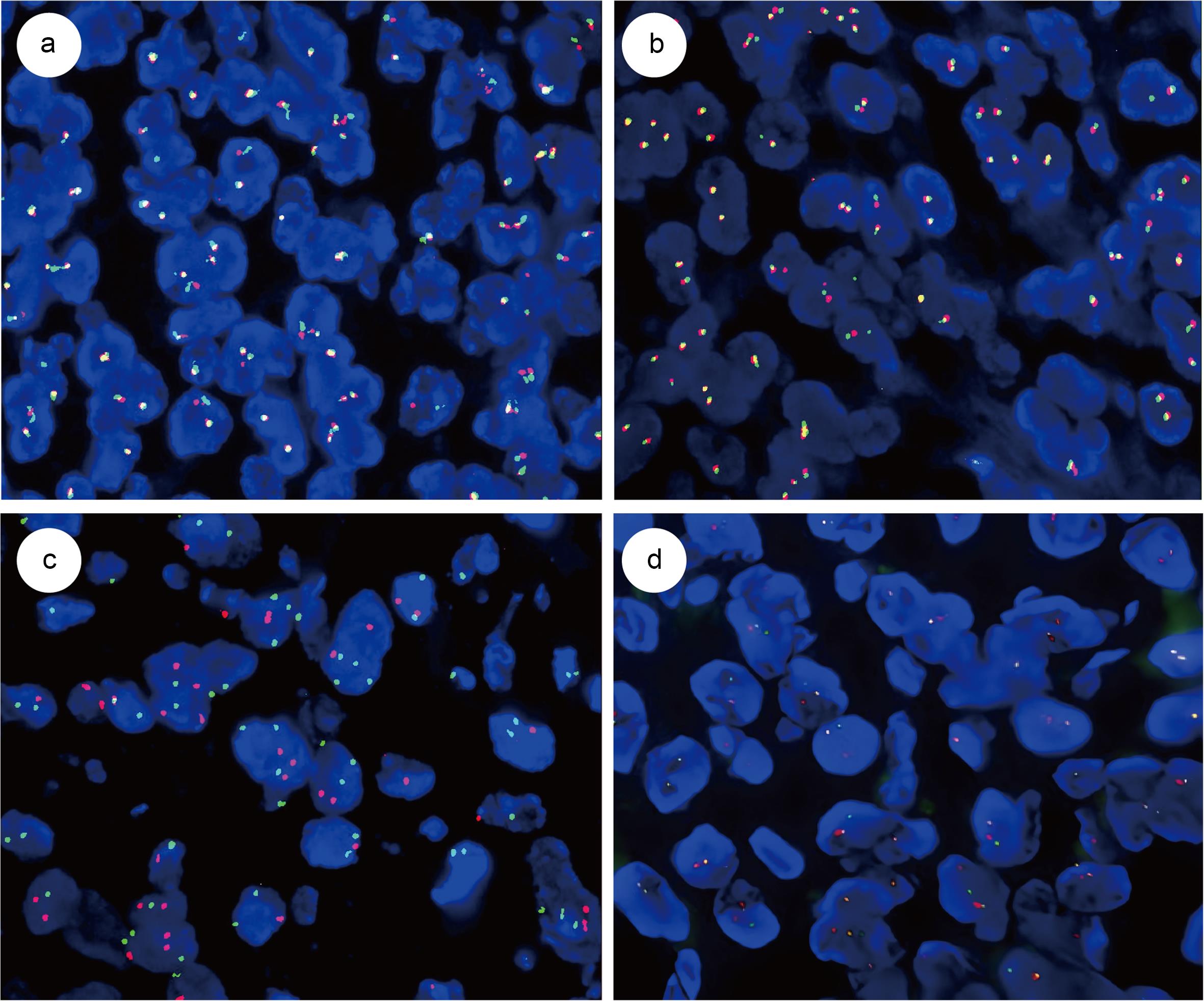 Fluorescence <italic>in situ</italic> hybridization (FISH) analyses showed negative results for <italic>CIC</italic> gene breakage (19q13) (a), <italic>EWSR1</italic> gene rearrangement (b), and <italic>ETV6::NTRK3</italic> fusion genes (t(12;15)) (c). The <italic>MALAT1</italic> break-apart probe (<italic>MALAT1</italic> red break-apart probe and <italic>MALAT1</italic> green break-apart probe) was used to assess 100 cells. The results showed 6% with a 1R1G signal pattern, 35% with a 1R1G1F pattern, and 3% with a 1R1G2F pattern, indicating the detection of a <italic>MALAT1</italic> gene rearrangement (d).