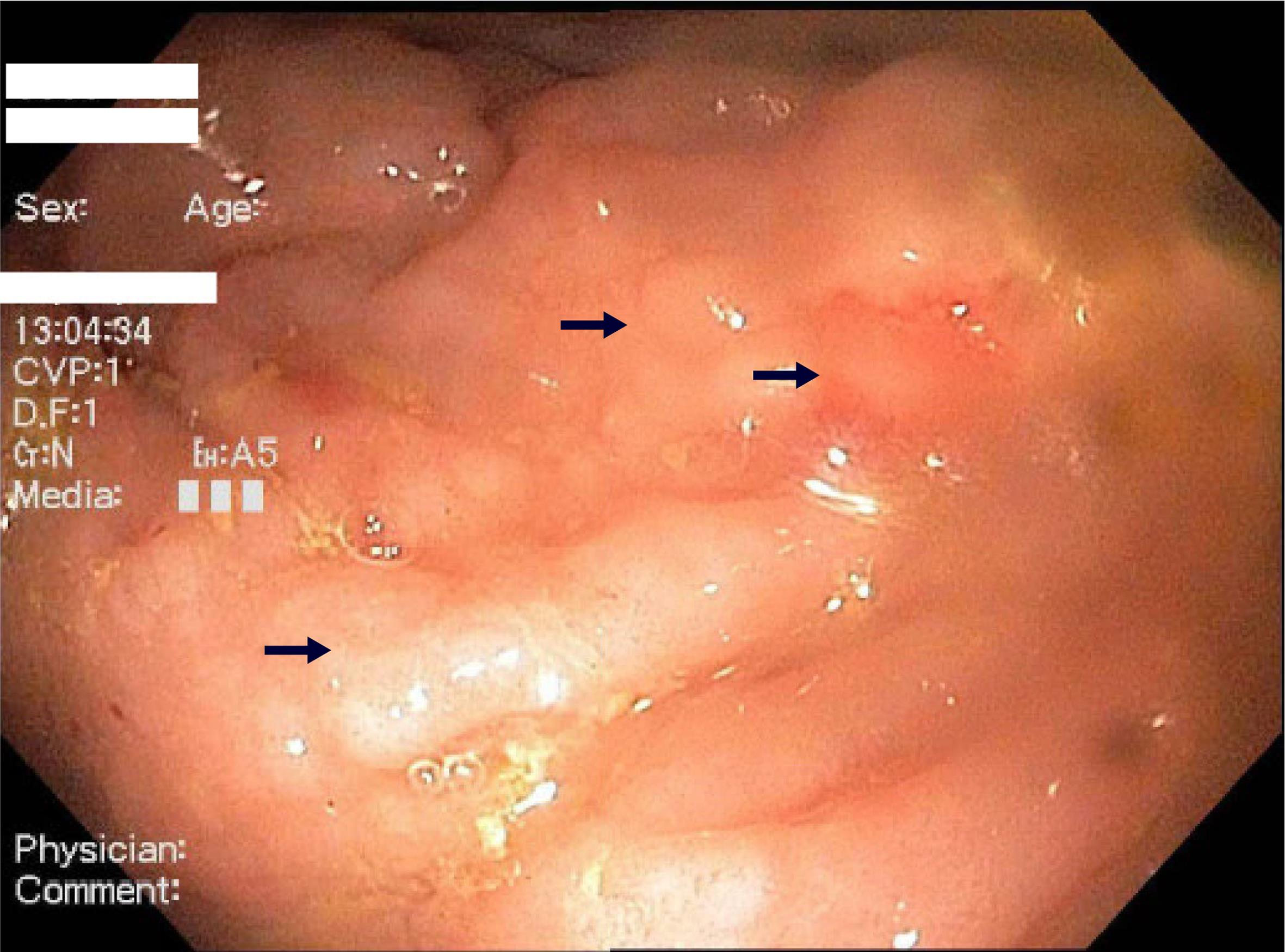 Nodular colonic mucosa (arrows) on colonoscopy corresponds to the site of metastases.