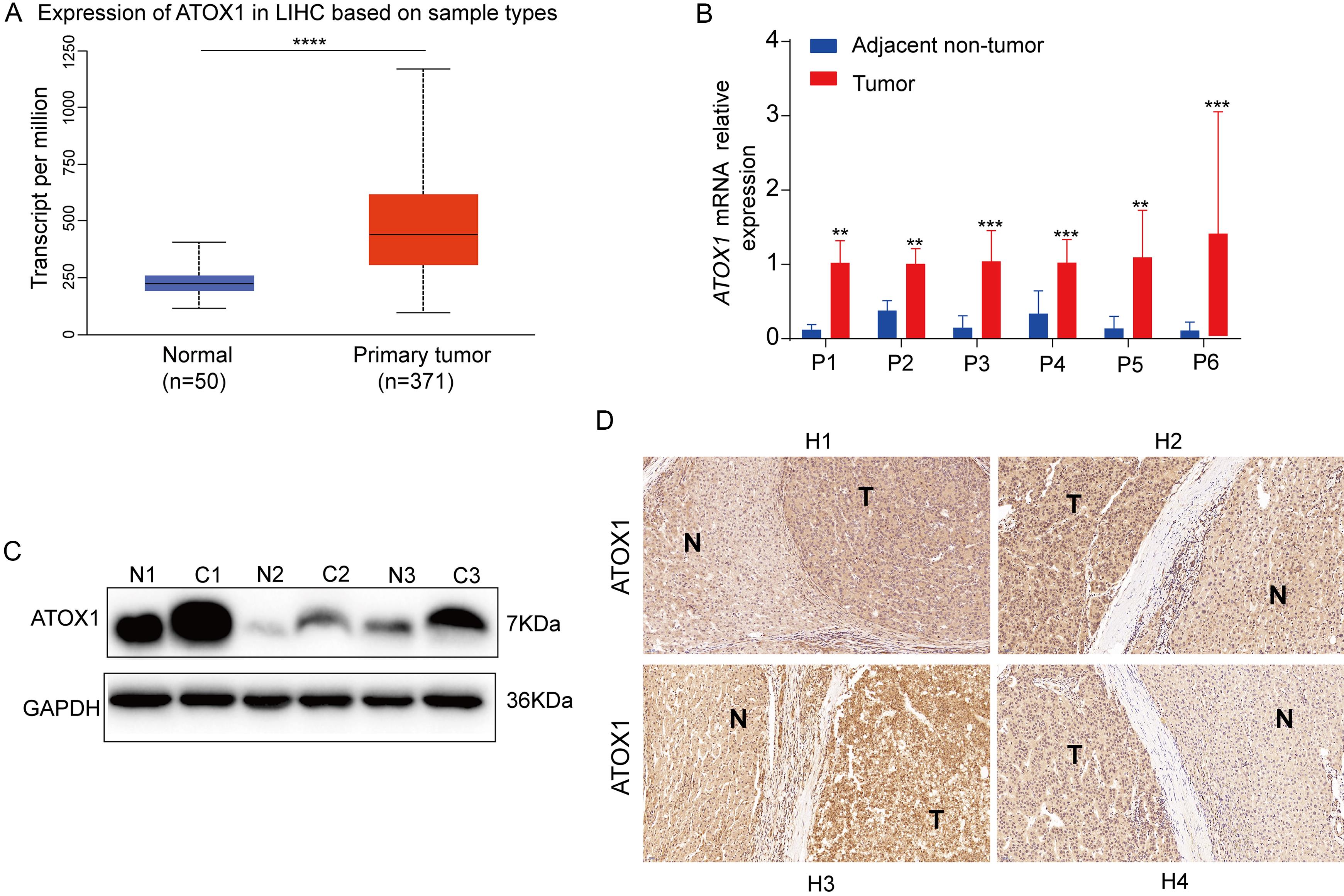 Expression profile of ATOX1 in HCC.