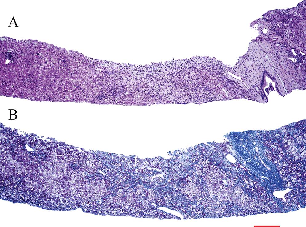 Liver specimen of a survivor obtained in the recovery stage of the self-limiting acute episode of the acute hepatic phenotype.