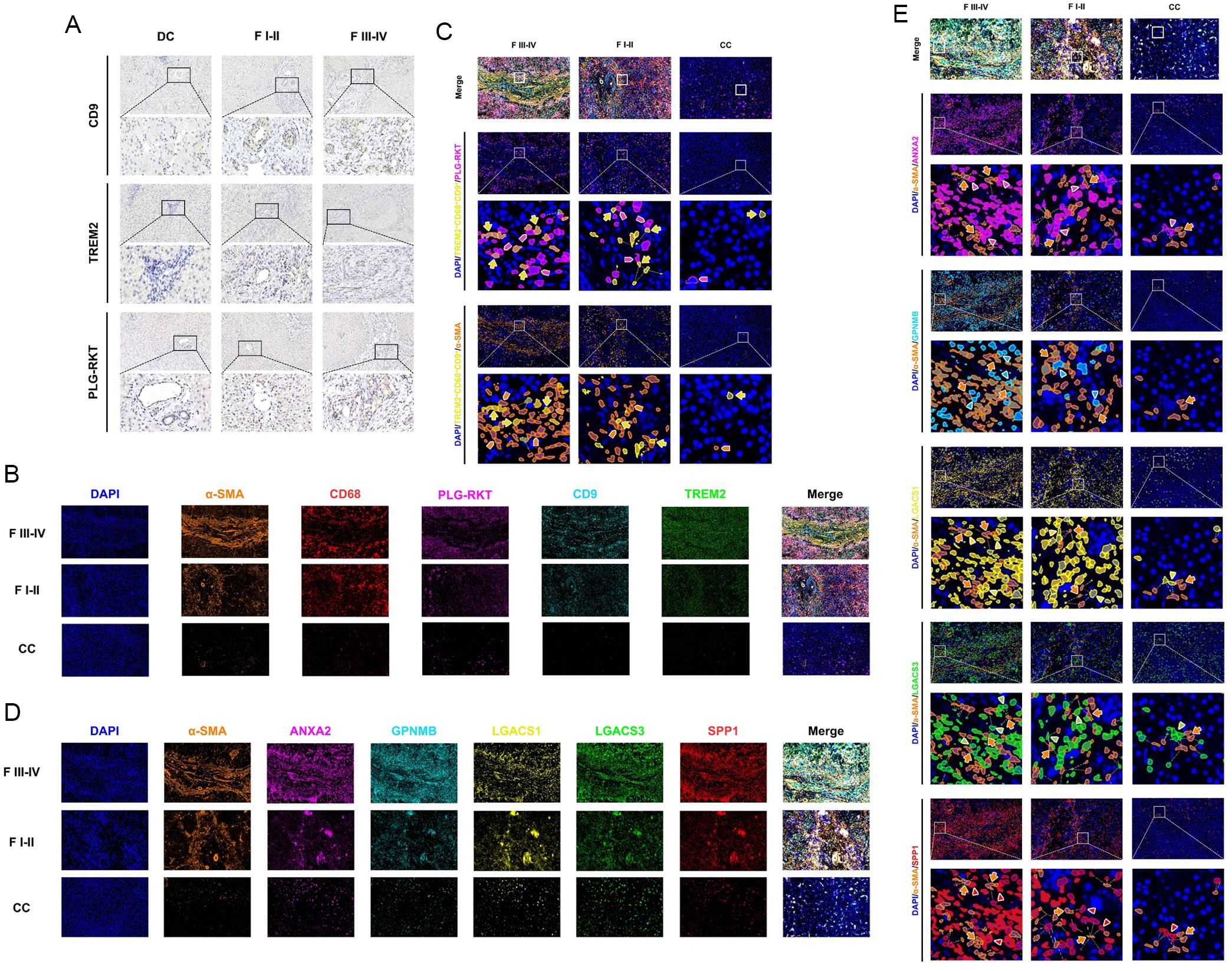 Immunohistochemical characterization of PLGRKT and SAM-associated markers in liver tissues.