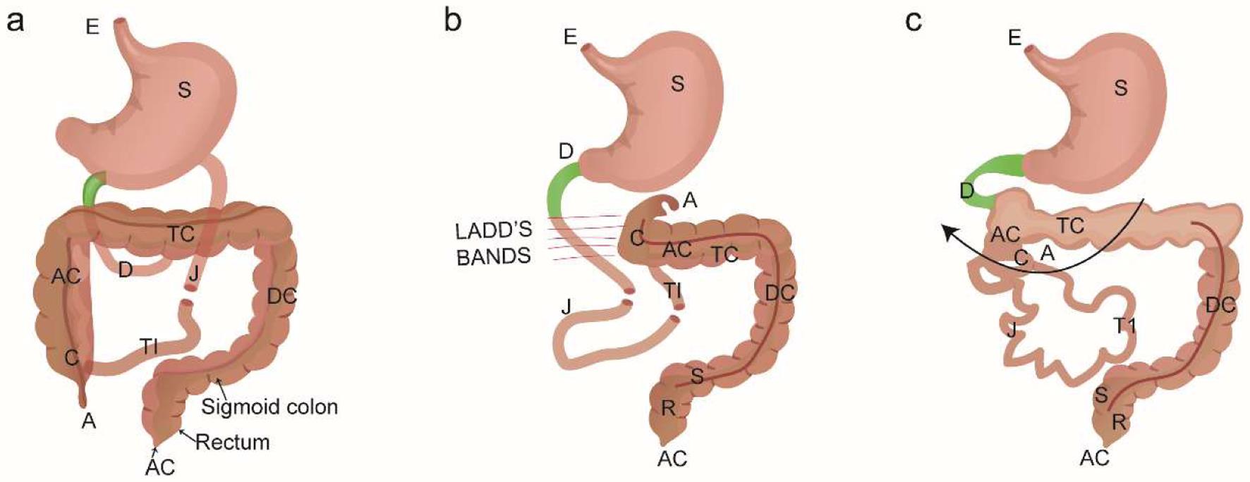 Midgut normal rotation, incomplete malrotation, and complete malrotation with volvulus.