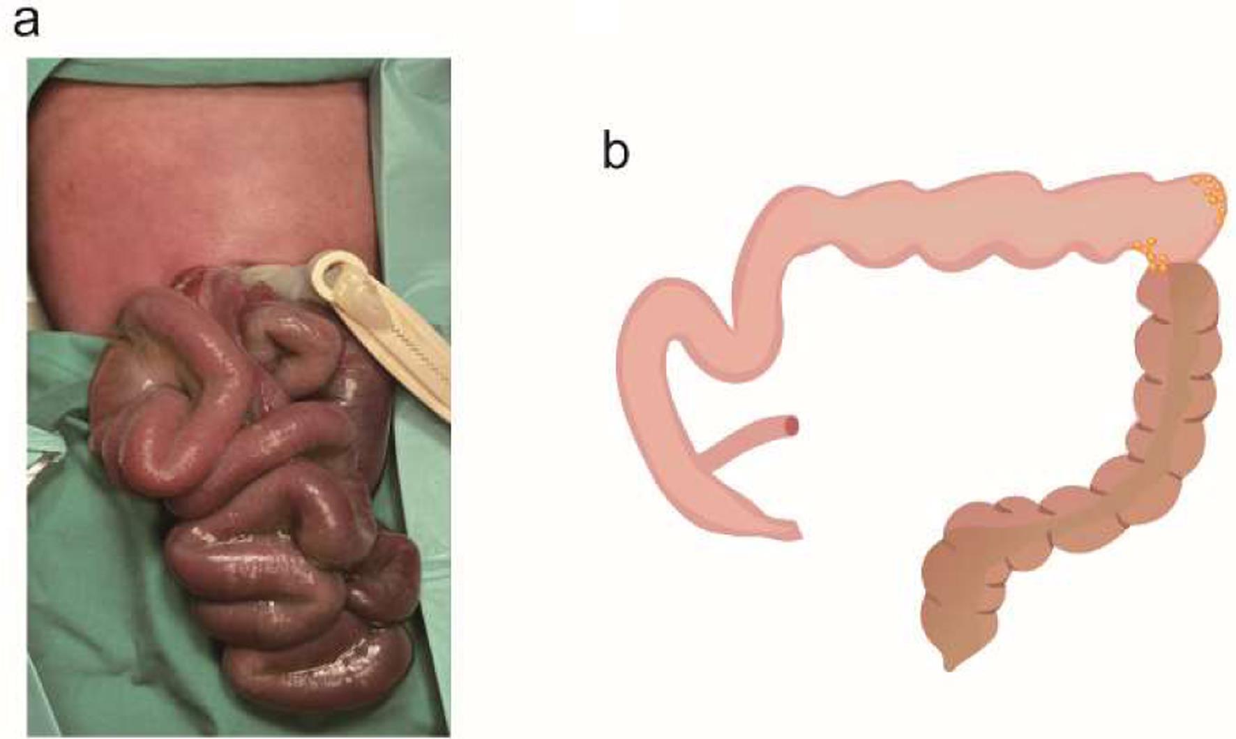 Appearance of gastroschisis at birth and water-soluble contrast enema in small left colon syndrome or fetal distress with functional partial hindgut obstruction.