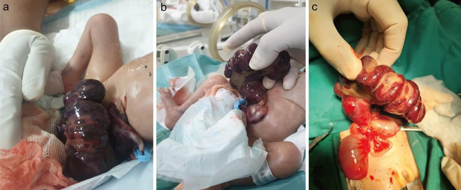 Giant closing midgut gastroschisis.