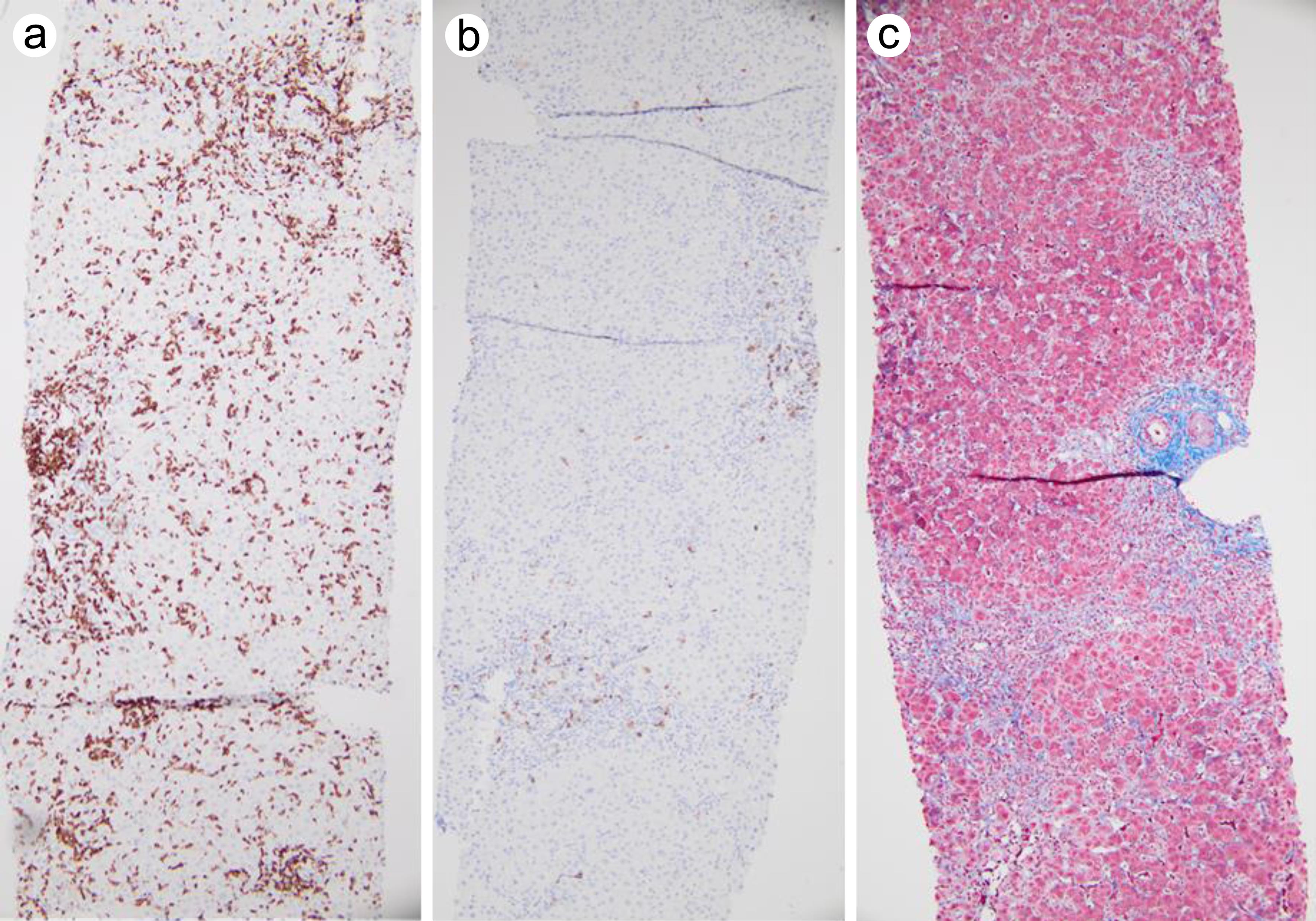 Immunostains and trichrome stain of liver biopsy.