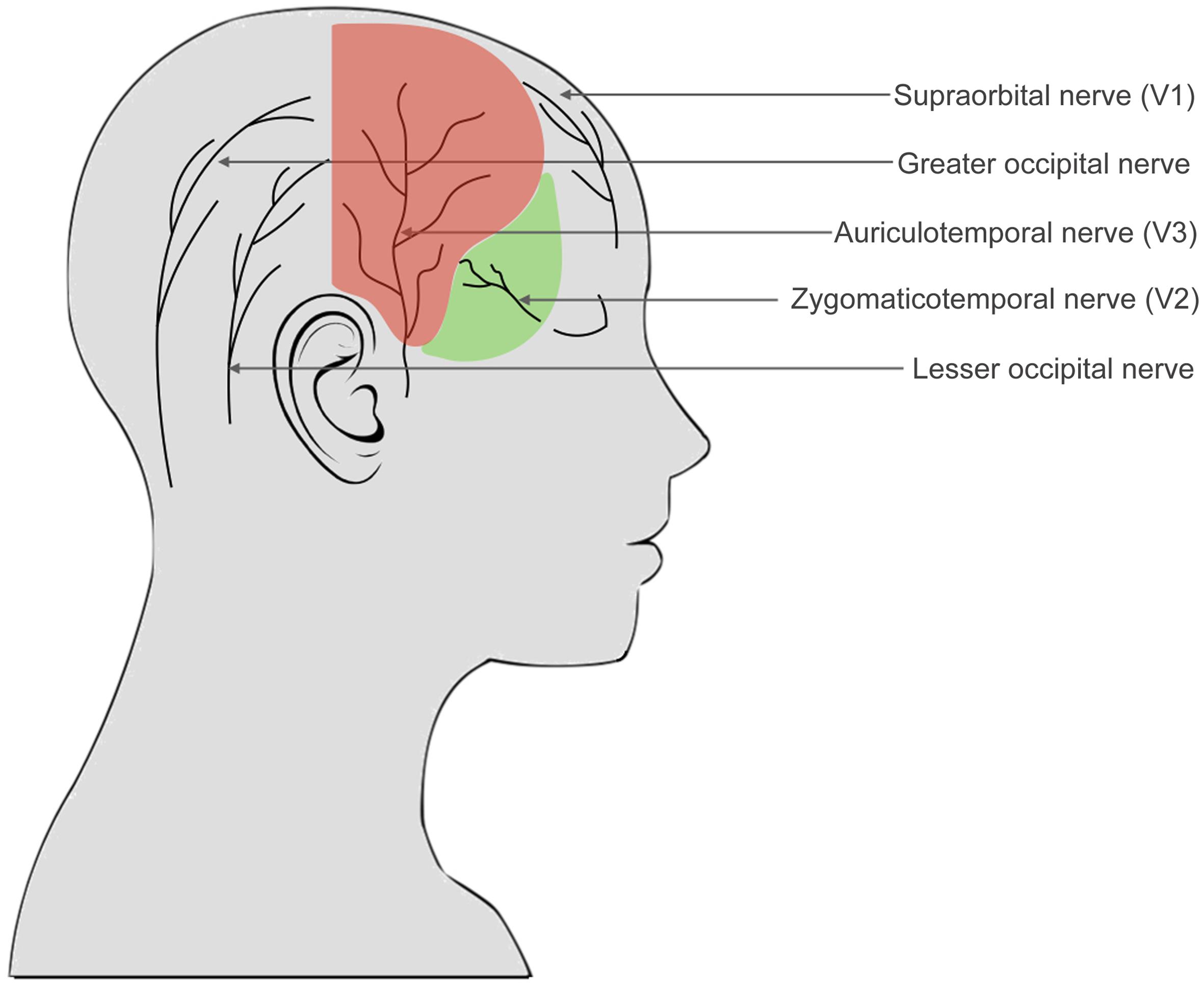 Illustration of pain sites in patients with atypical trigeminal neuralgia (ATN).