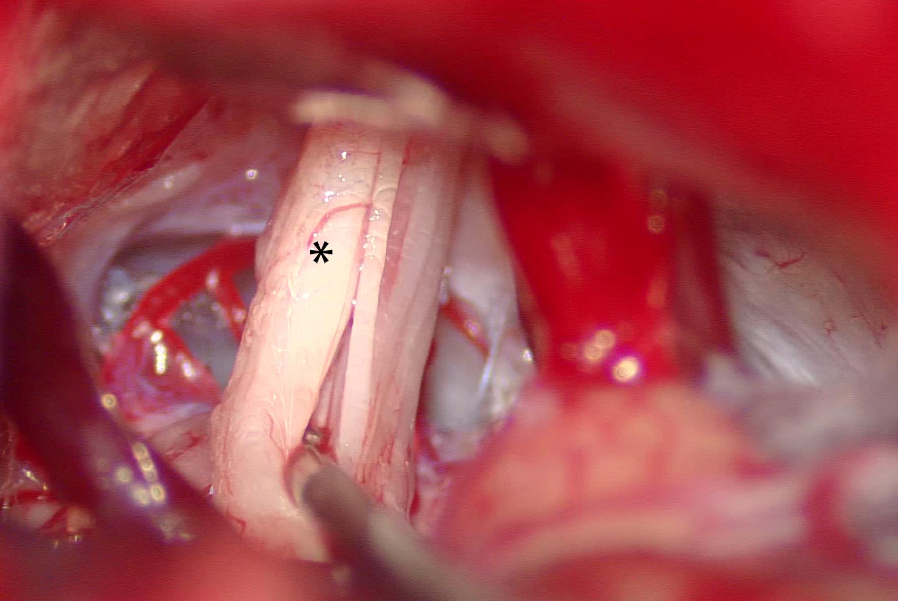 Nerve combing of the trigeminal nerve.