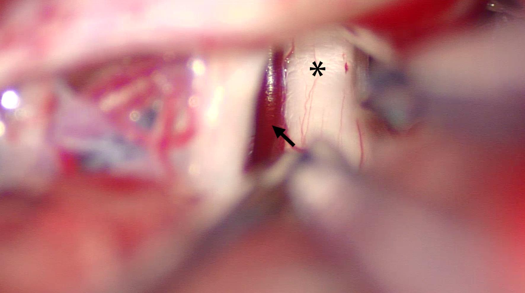 Veins identified in the operative field during MVD.