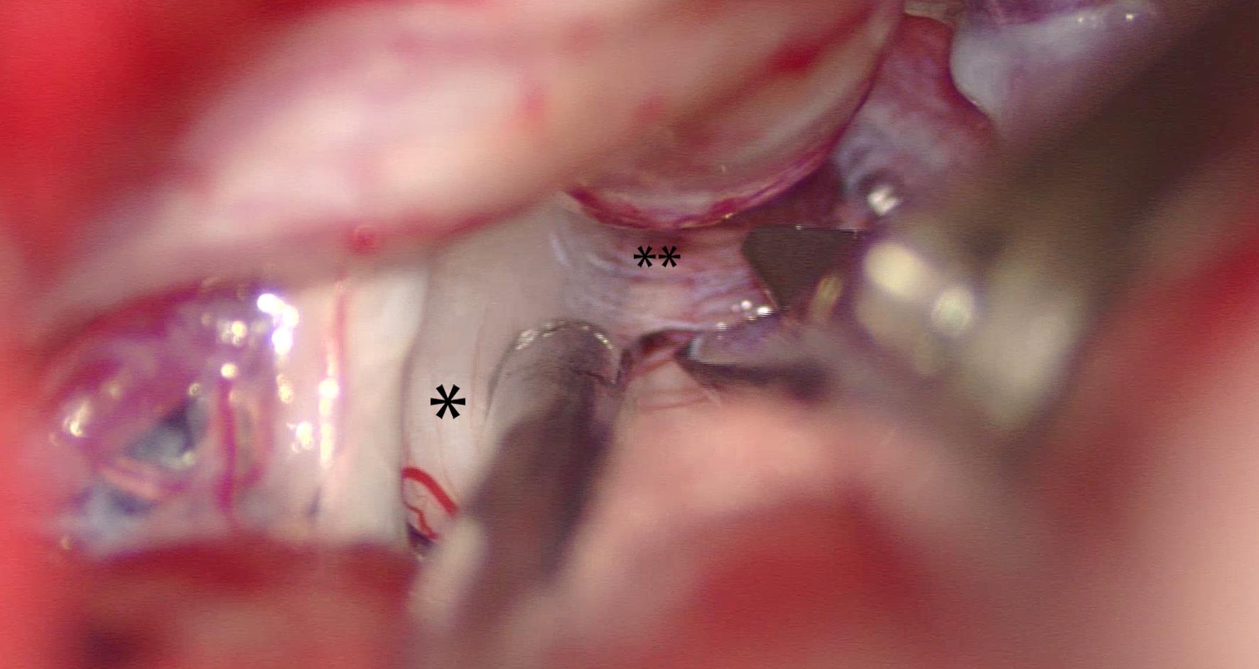 Arachnoid adhesions (AA) compressing the trigeminal nerve observed during MVD.