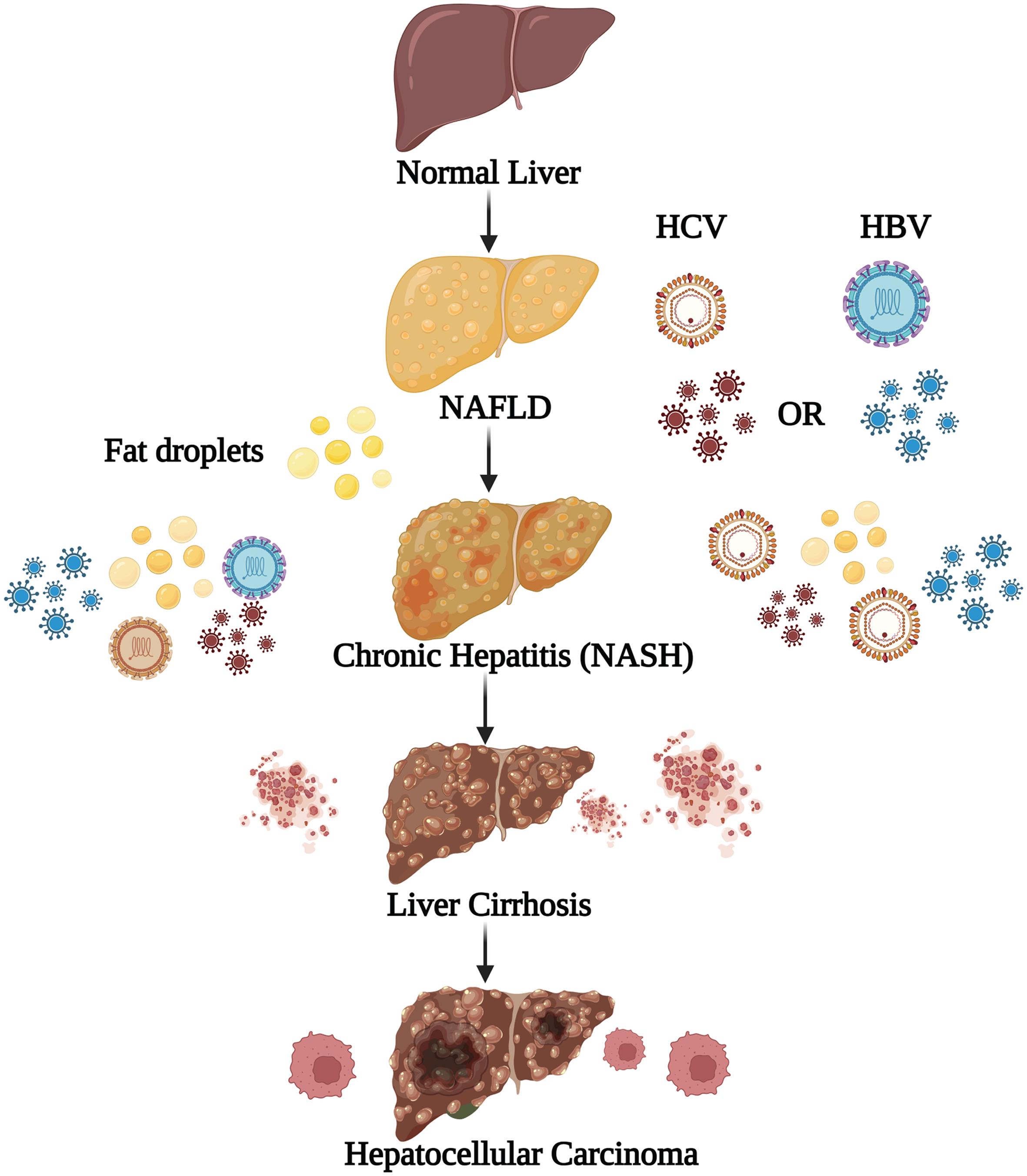 Different stages involved in the transfer of normal liver into hepatocellular carcinoma.