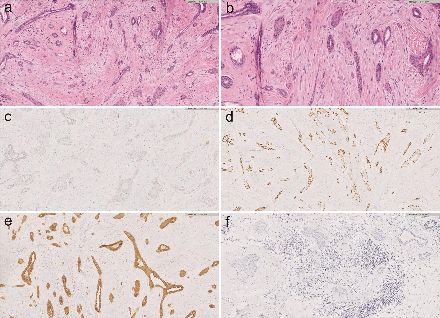 Low-grade adenosquamous carcinoma of the breast shows infiltrative solid glandular ducts into surrounding stroma (a), which are composed of low-grade, bland looking cells with squamous and glandular components (b). Myoepithelial cells are absent around the tumor in smooth muscle myosin heavy chain (SMMS) staining (c). The tumor cells are diffusely positive for p40 (d) and cytokeratin 5 (CK5) (e), but negative for estrogen receptor (ER) (f). b, ×20; others, ×10.