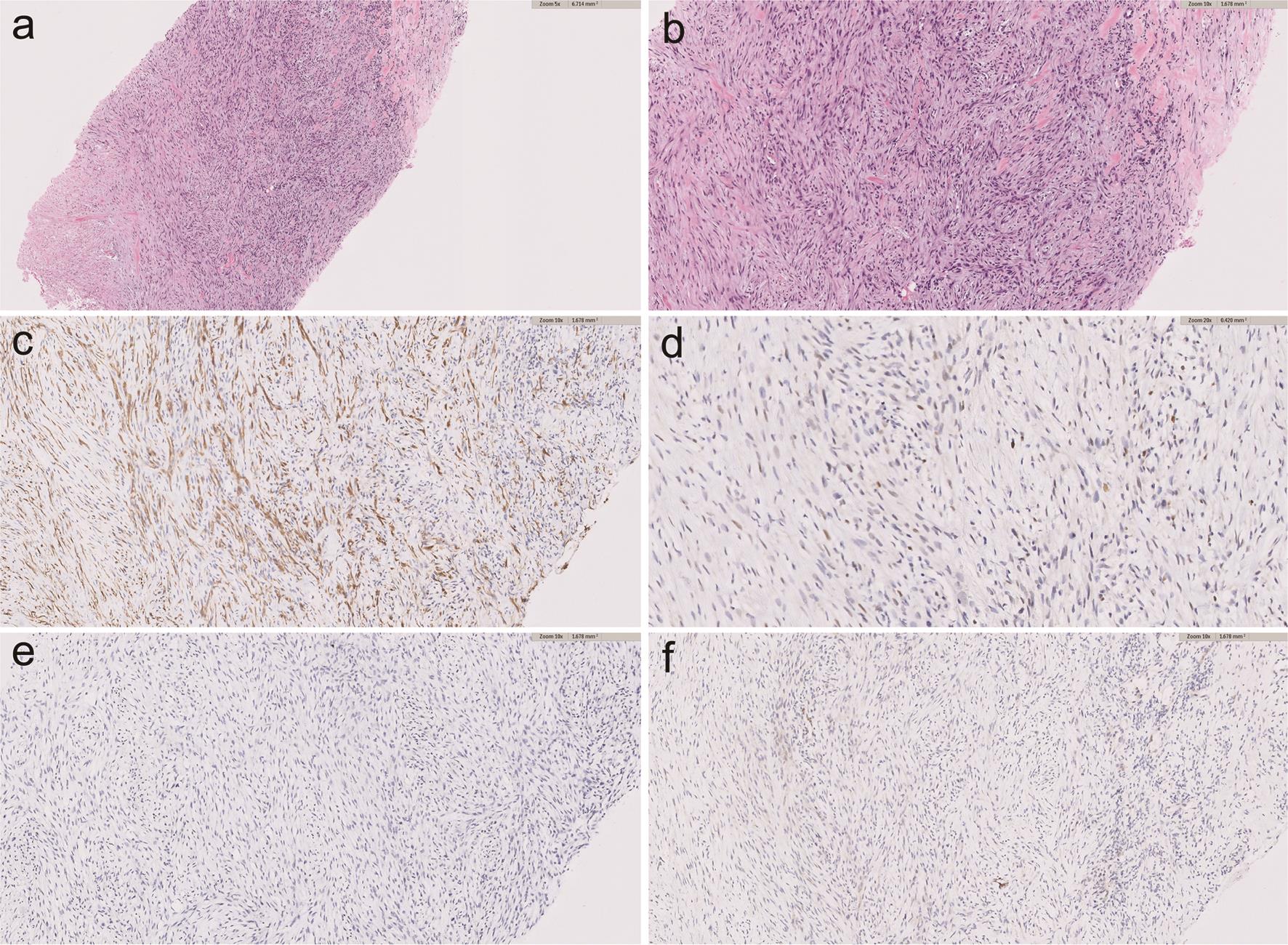 Fibromatosis-like spindle cell carcinoma shows the tumor infiltrates into the surrounding breast parenchyma (a). The tumor is composed of cytologically bland spindle shaped cells with small round to oval nuclei. Also note the lack of mitotic figures (b). The tumor cells are positive for AE1/AE3 (c), focally positive for GATA binding protein 3 (GATA3) (d), and negative for ER (f) and desmin (f). a, ×5; b–c, e–f, ×10; d, ×20.