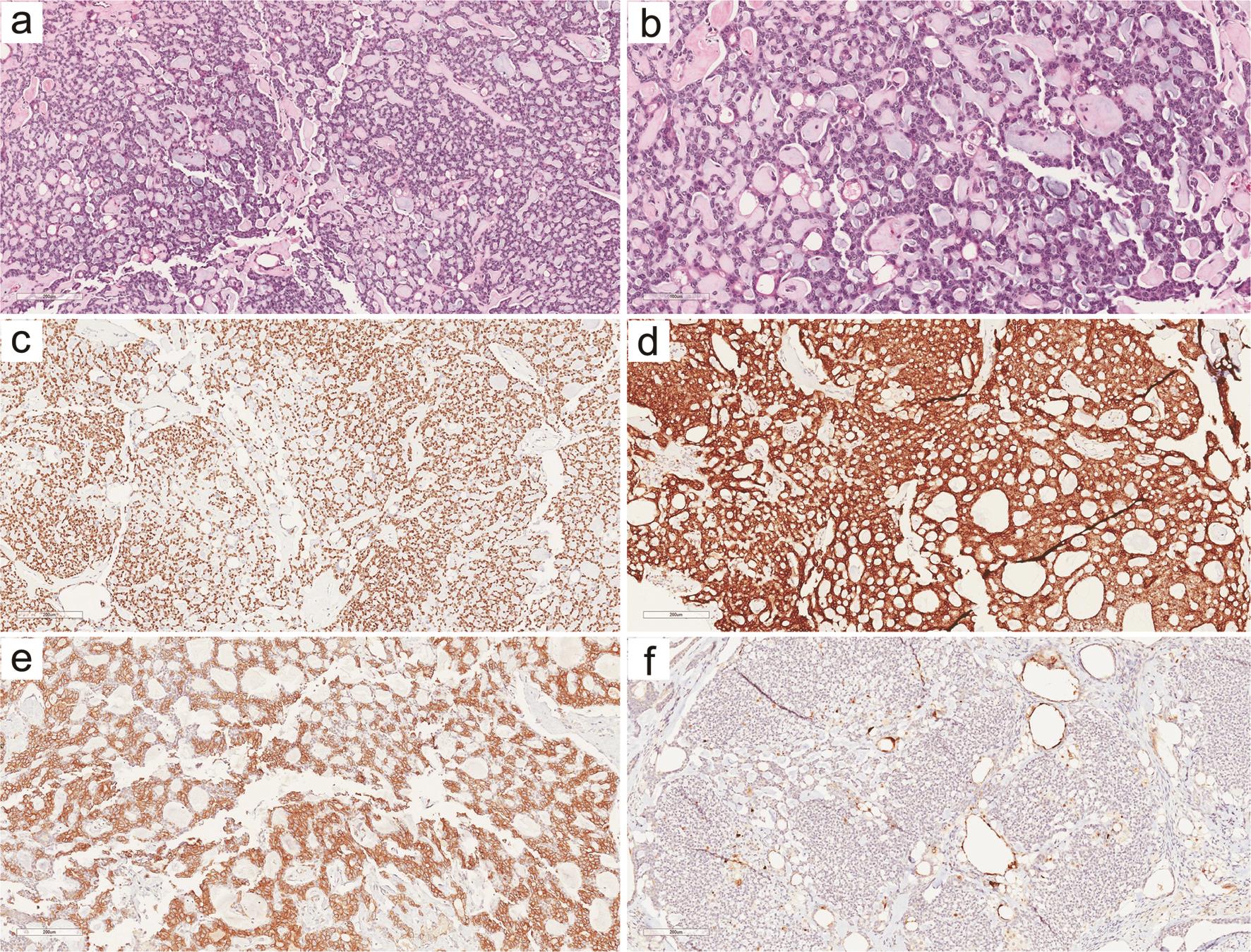 Classic adenoid cystic carcinoma of the breast shows cribriform growth pattern (a). Eosinophilic globular material is present in the lumen of cribriform structures, which are composed of low-grade basaloid tumor cells (b). P63 is positive in the basaloid cells (c). Luminal epithelial cells are diffusely positive for CK5 (d) and c-Kit (CD117) (e). The tumor cells are negative for ER (f), GATA3 (g) and Trichorhinophalangeal syndrome type 1 (TRPS1) (h). b, ×20; others, ×10.