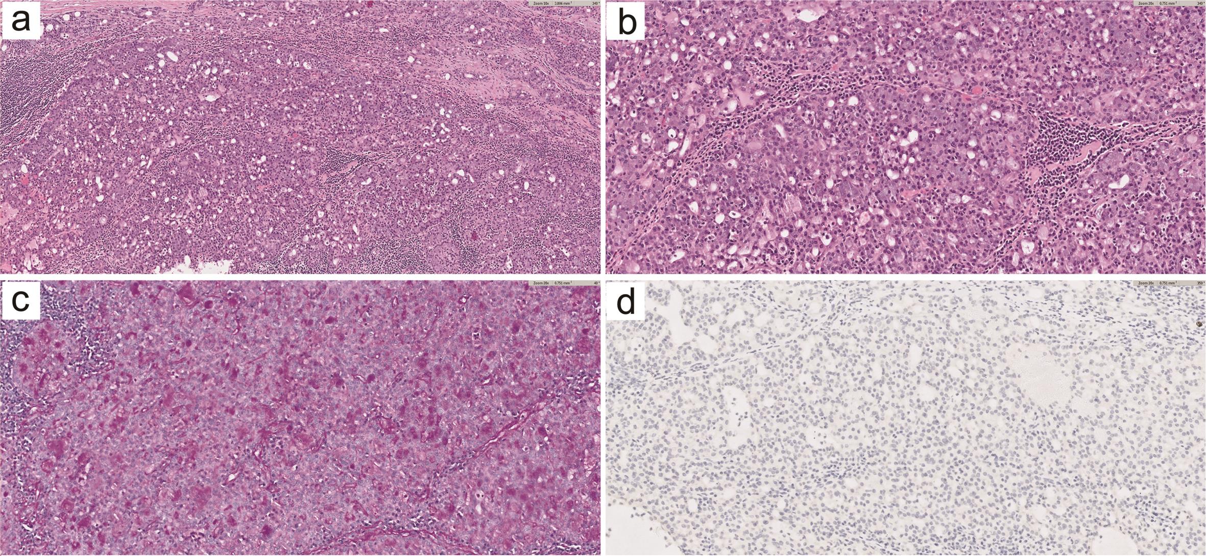 Acinic cell carcinoma of the breast.