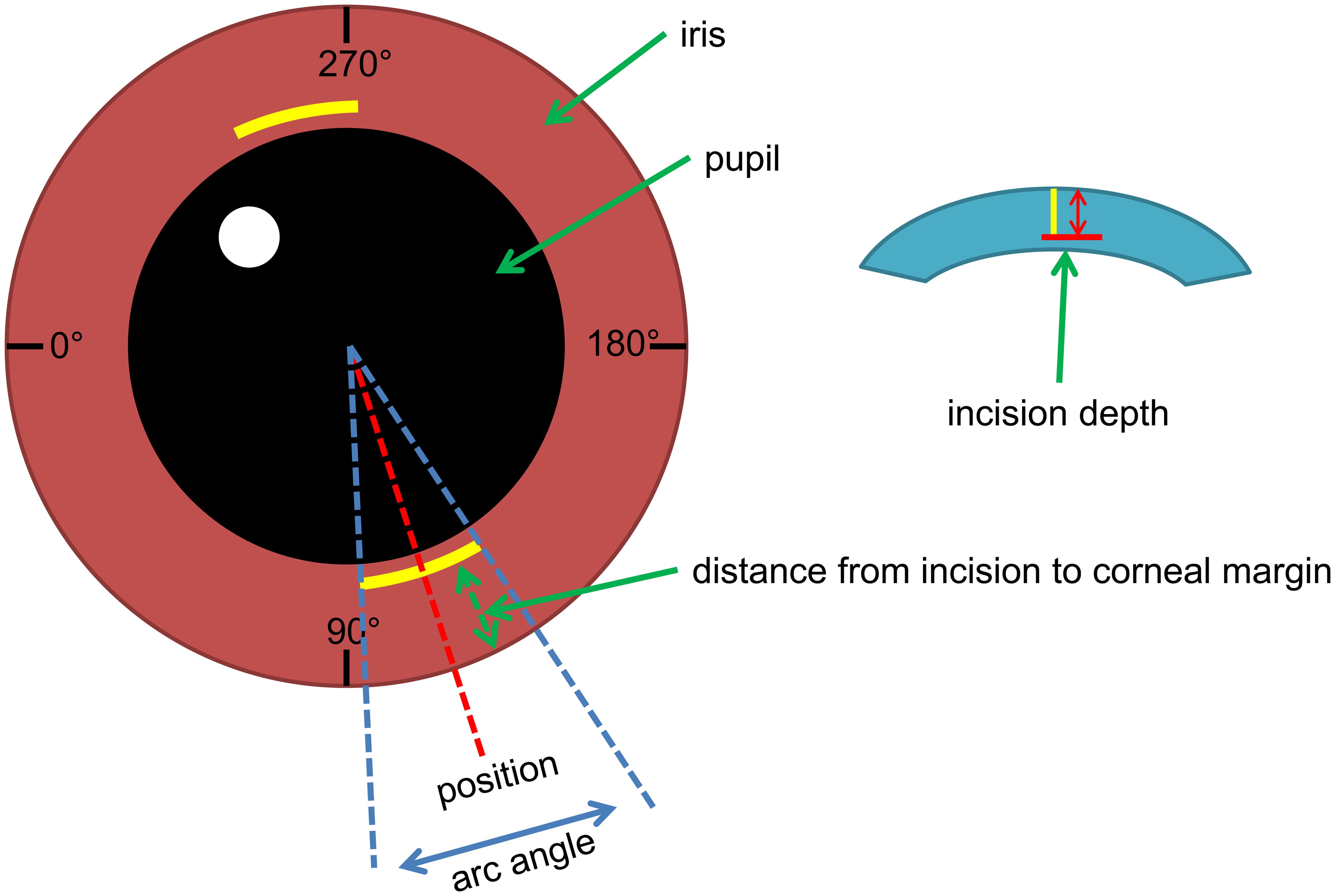The surgical parameters in the femtosecond laser-assisted arcuate keratotomy procedure for astigmatism correction.