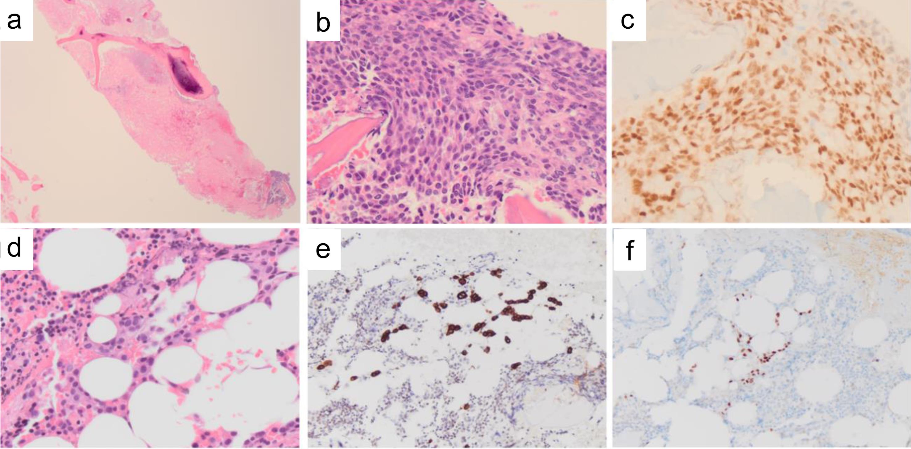Representative microphotographs of a conspicuous (a–c), and a subtle (d–f) case of bone marrow metastasis.