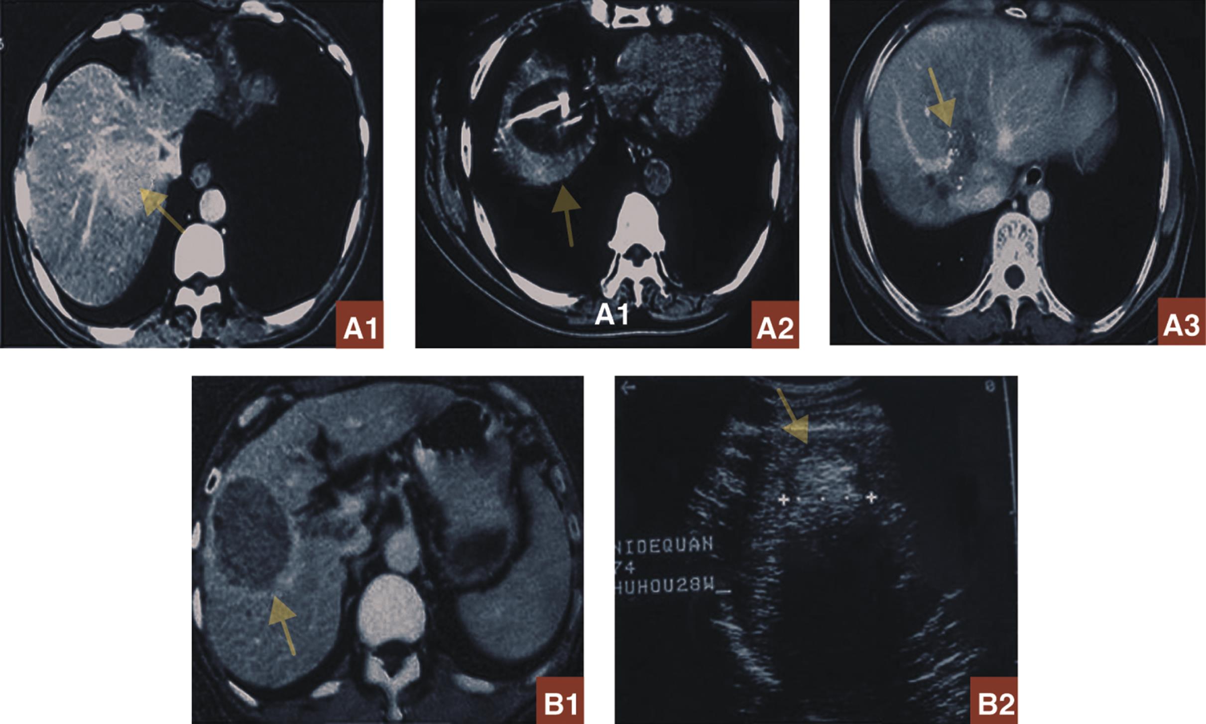CT images of two patients (A and B) with HCC who underwent PC.