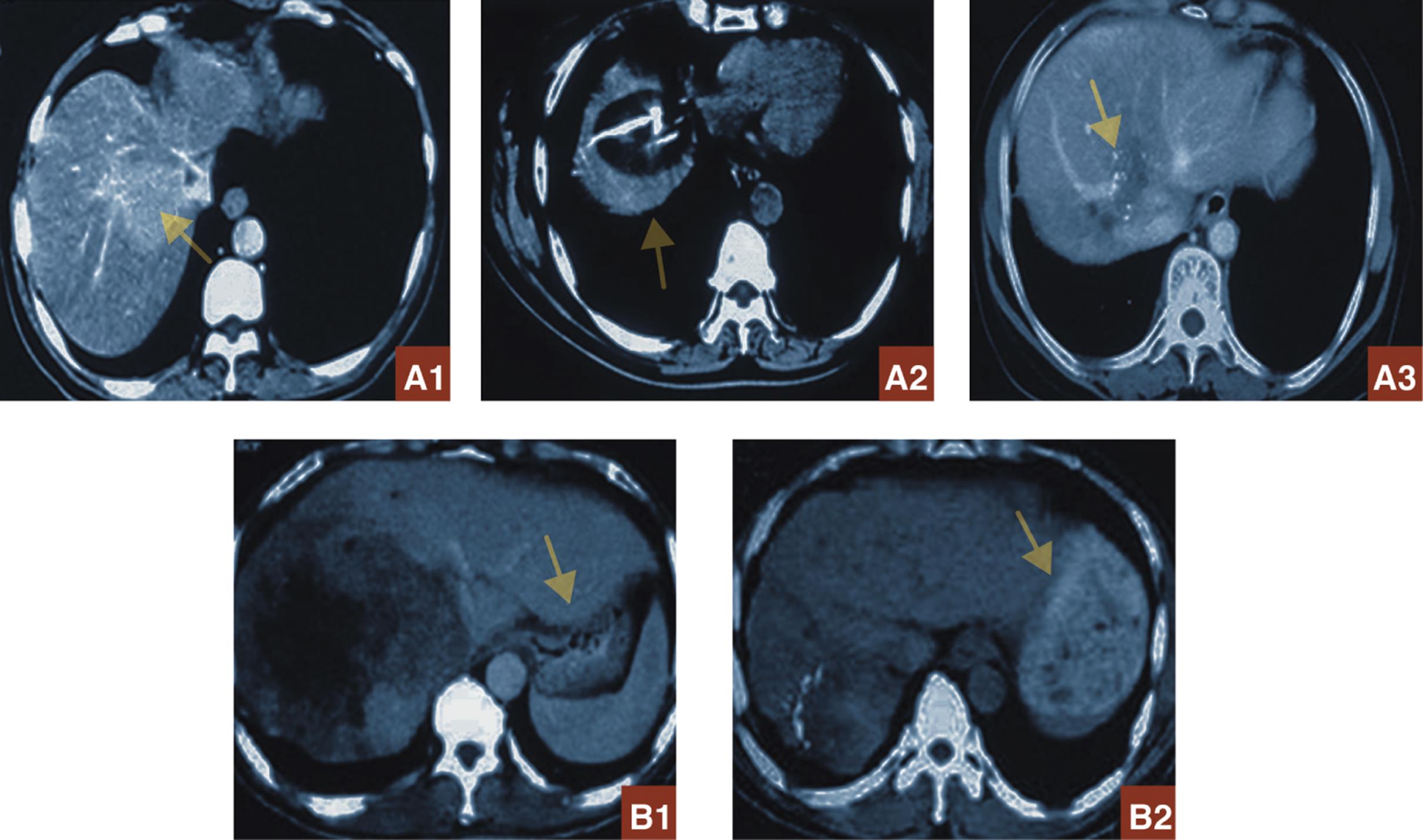 Liver imaging in two patients (A and B) with hepatic colorectal metastases.