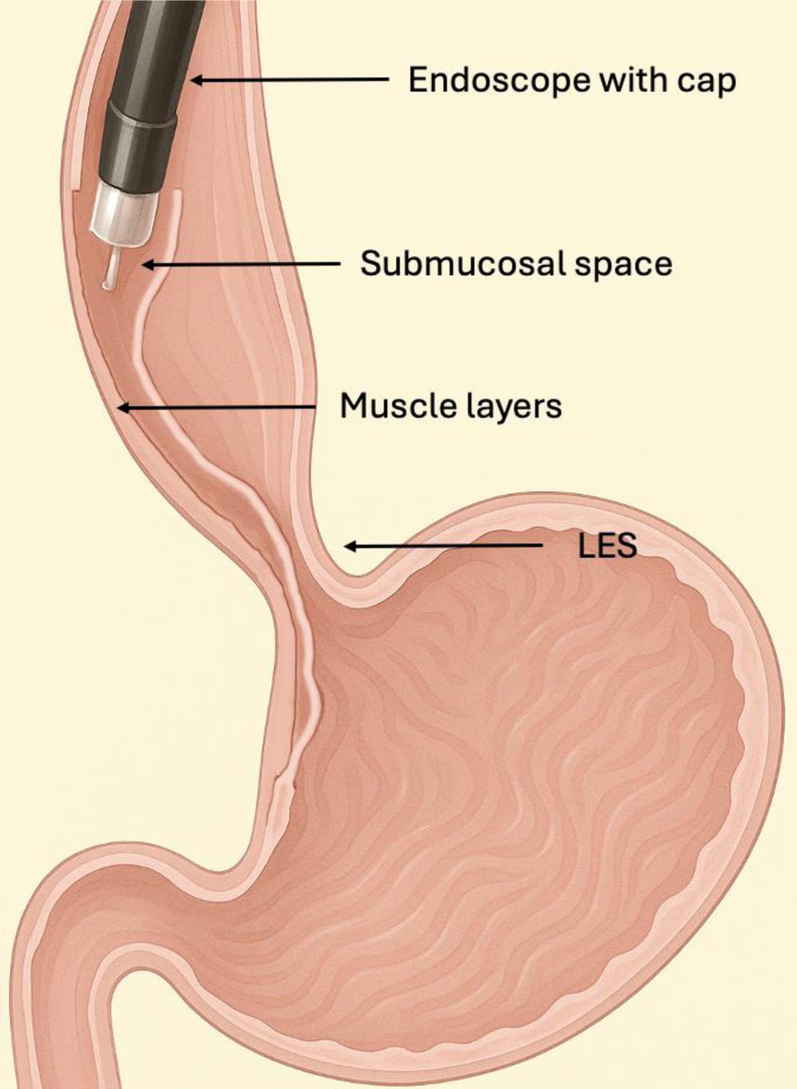 POEM procedure: Cross-sectional schematic of the distal esophagus and gastric cardia after submucosal tunnel formation and just before myotomy creation.