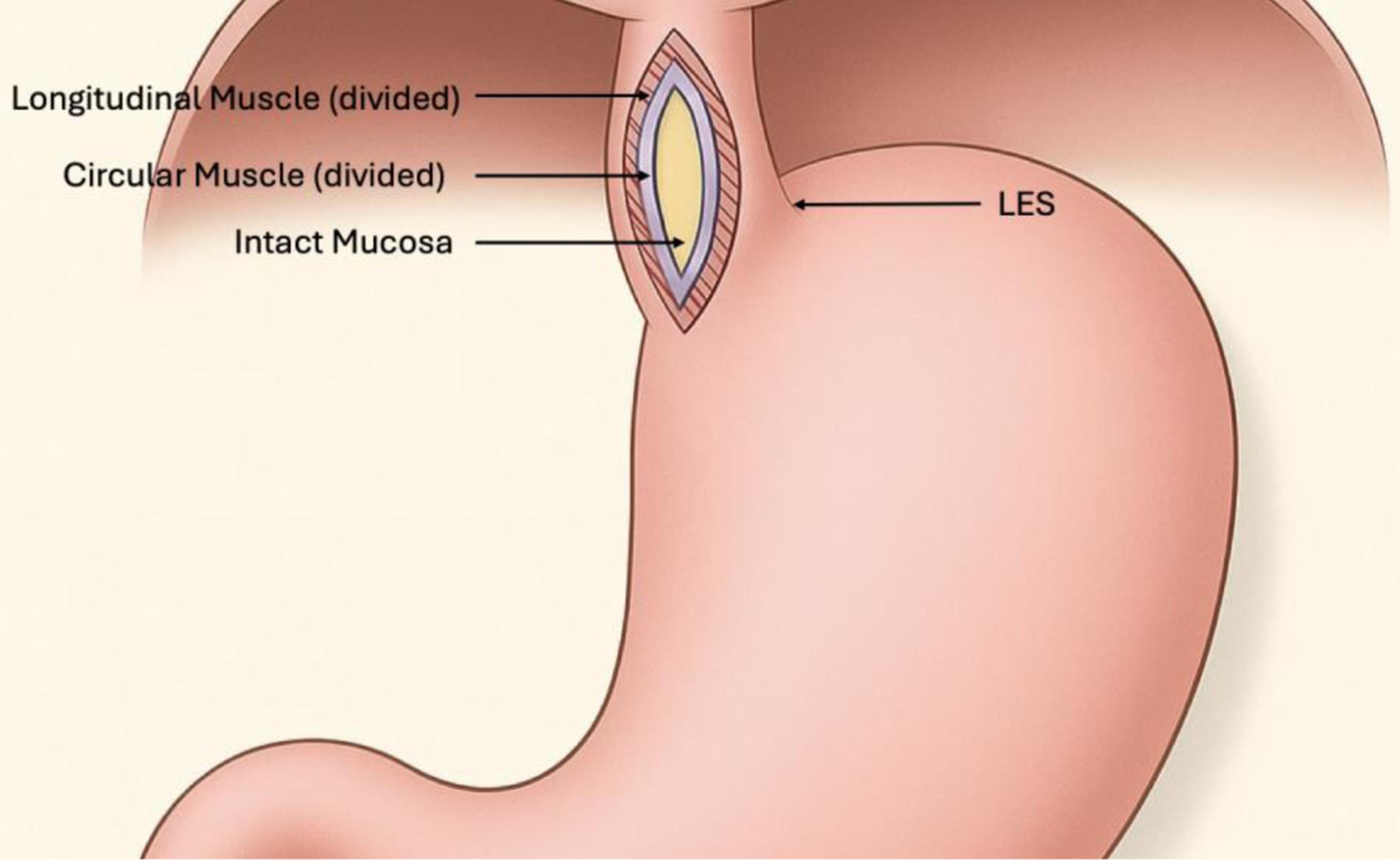 LHM procedure: Intra-abdominal laparoscopic view of a completed Heller myotomy.