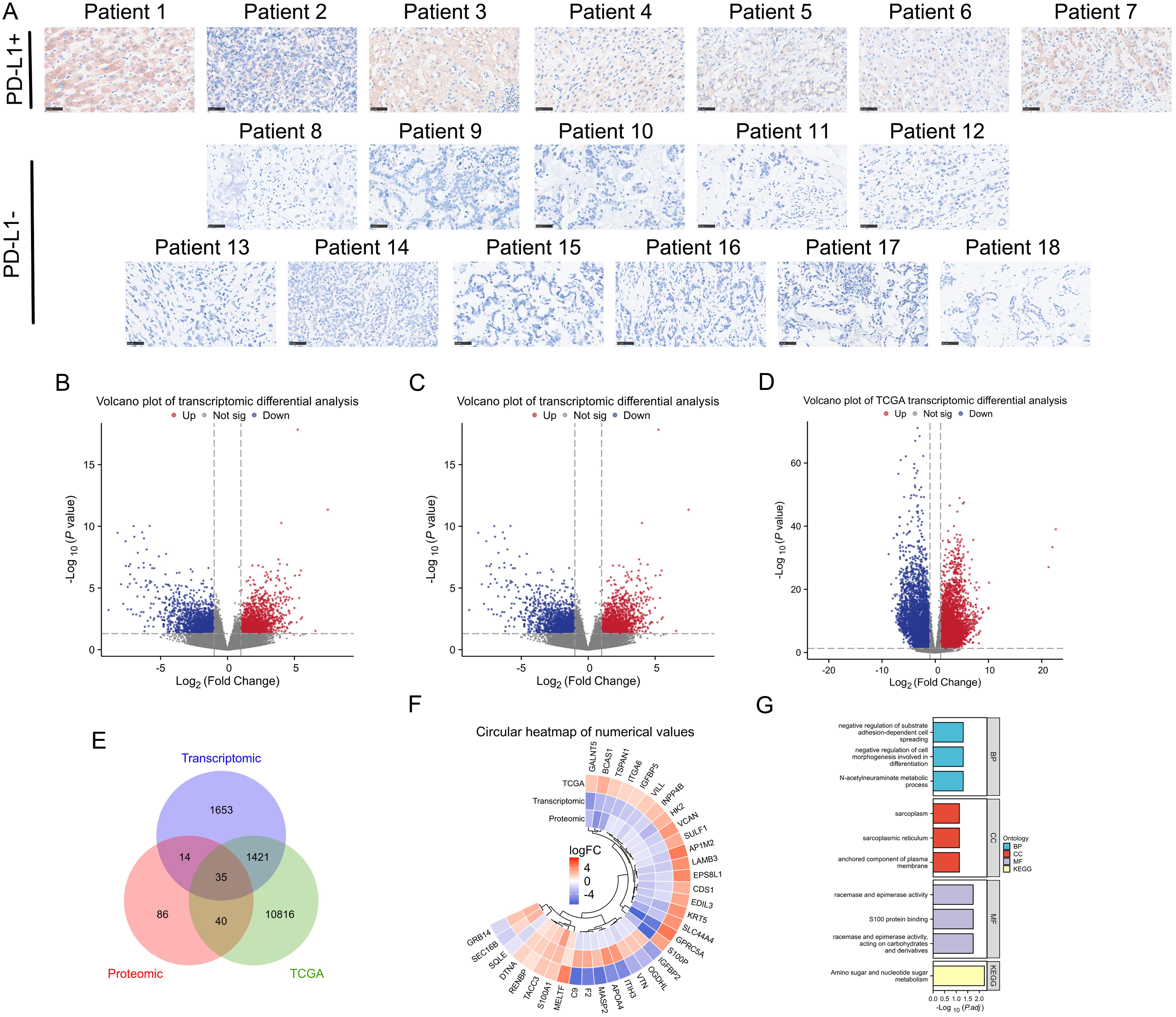 Multi-omics screening for candidate genes in ICC.