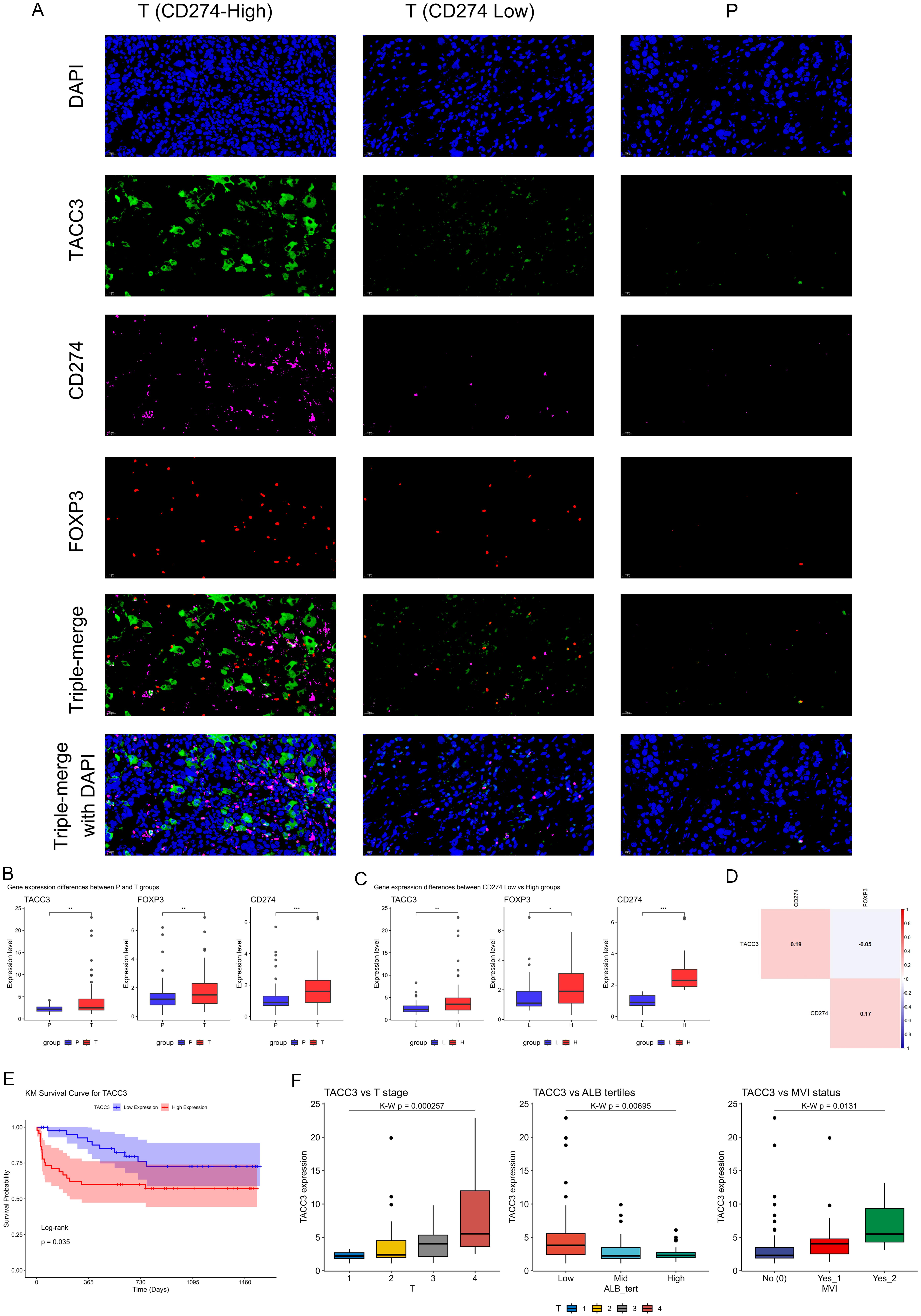TACC3, CD274, and FOXP3 protein co-expression and their clinical relevance in ICC.