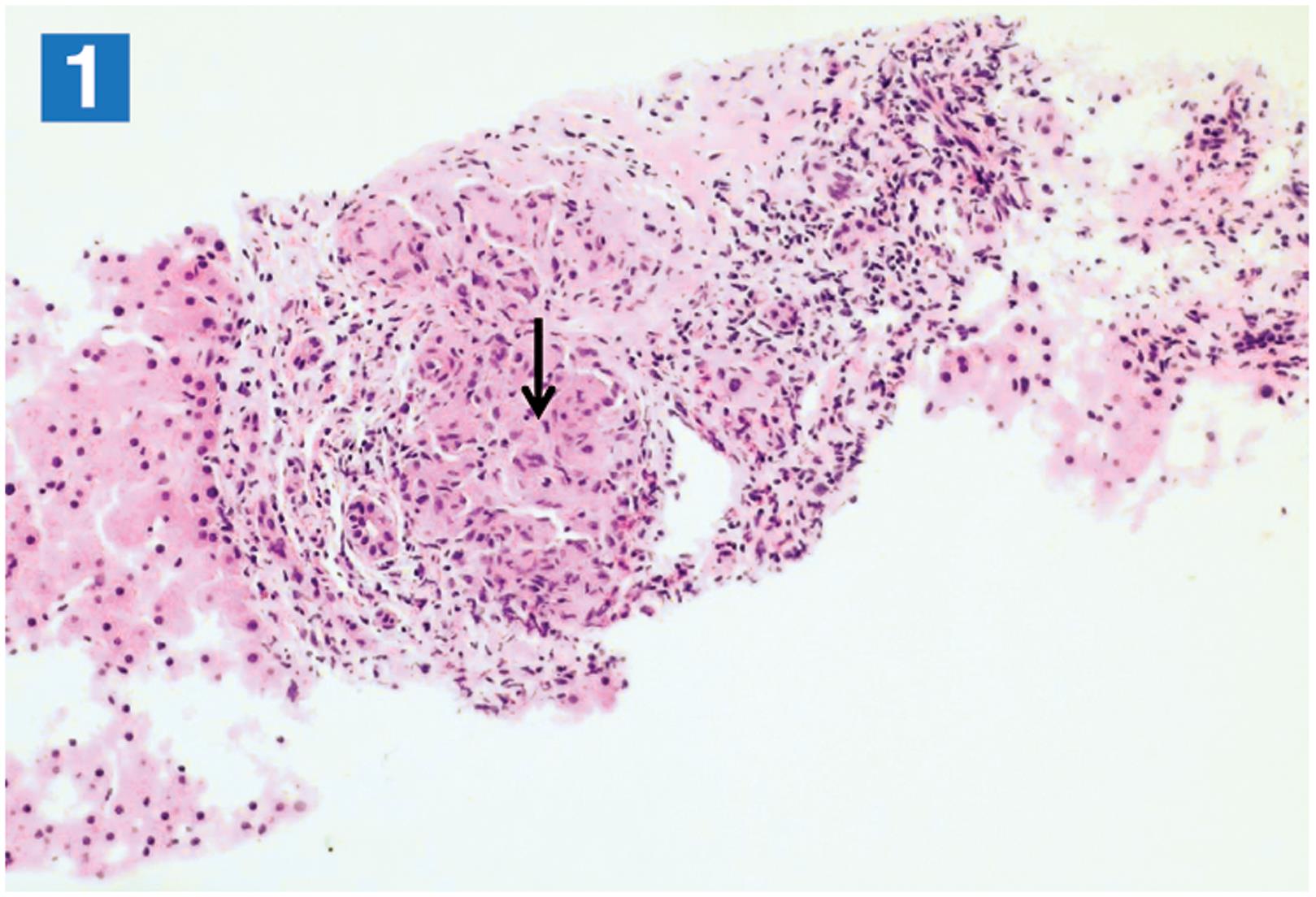 A liver biopsy specimen showing a single portal epithelioid granuloma (arrow) surrounded by a thin cuff of lymphocytes