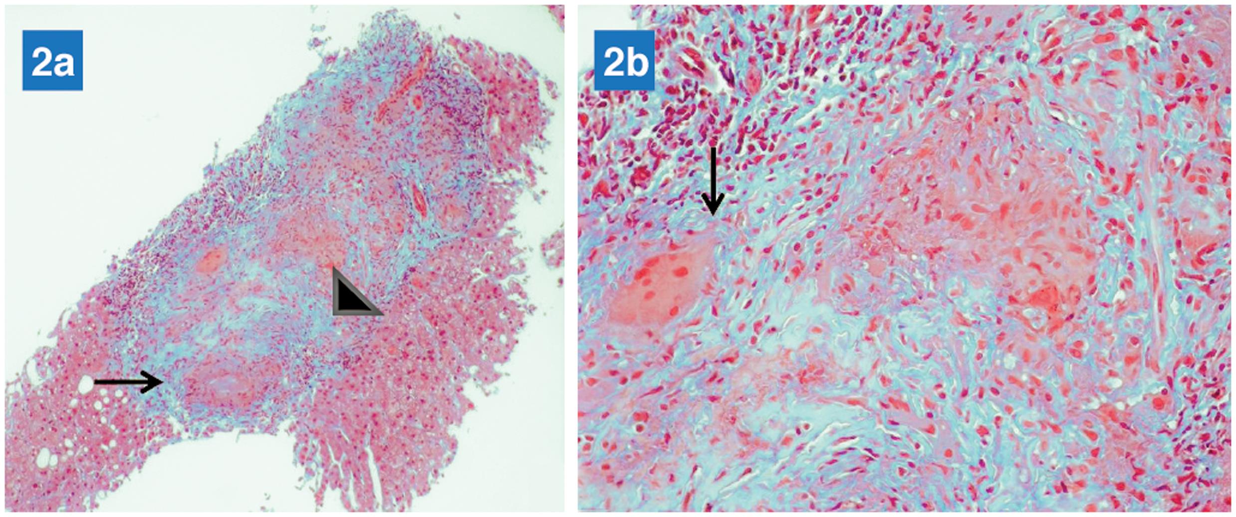 A liver biopsy specimen showing: a, a conglomerate of granulomatous reaction (arrow) with significant fibrosis (arrow head); b, significant as well conglomerate of epithelioid granulomas with giant cells (arrow), but without necrosis