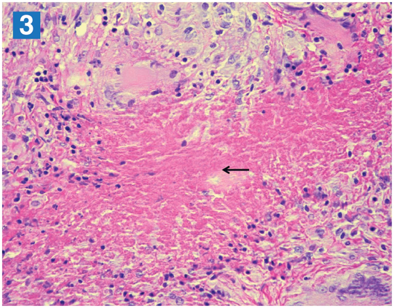 A liver biopsy specimen showing a sarcoid granuloma in liver with central fibrinoid necrosis (arrow)