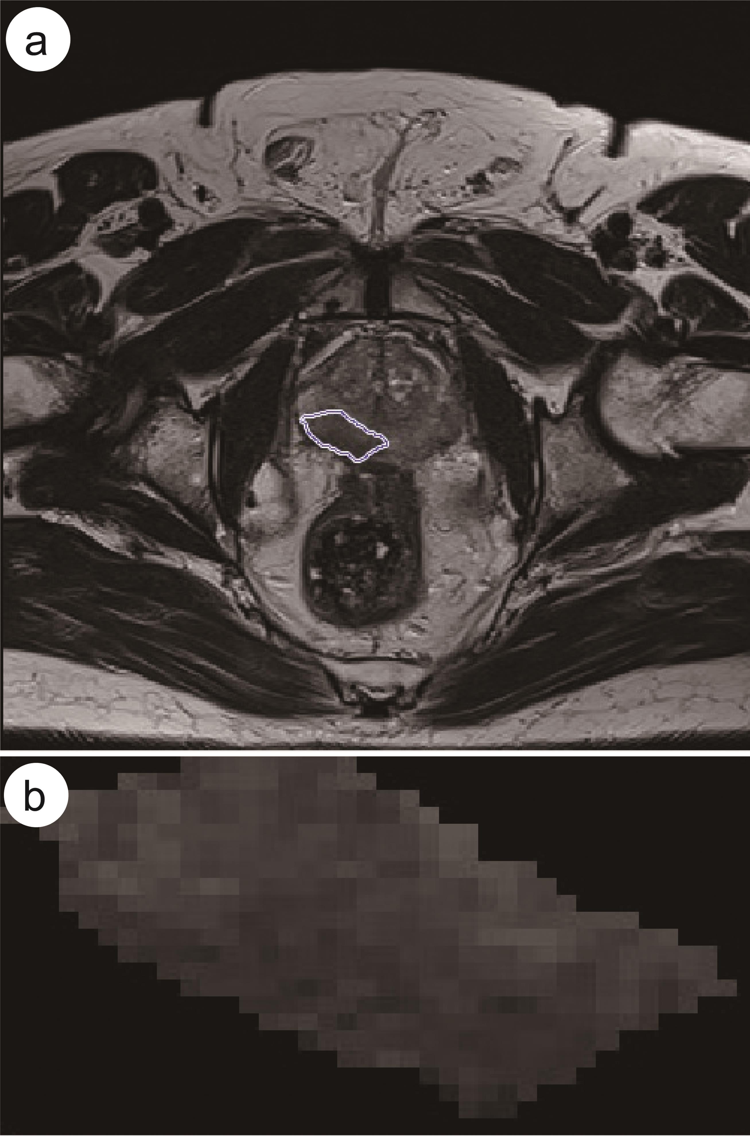Prostate MR image of a 70-year-old cancer patient with a Gleason score 9 (4 + 5) and stage 3 (Case 1): (a) outlined with a freehand ROI tool on T2 WMR sequence; and (b) cropped ROI (22 × 38 pixels).