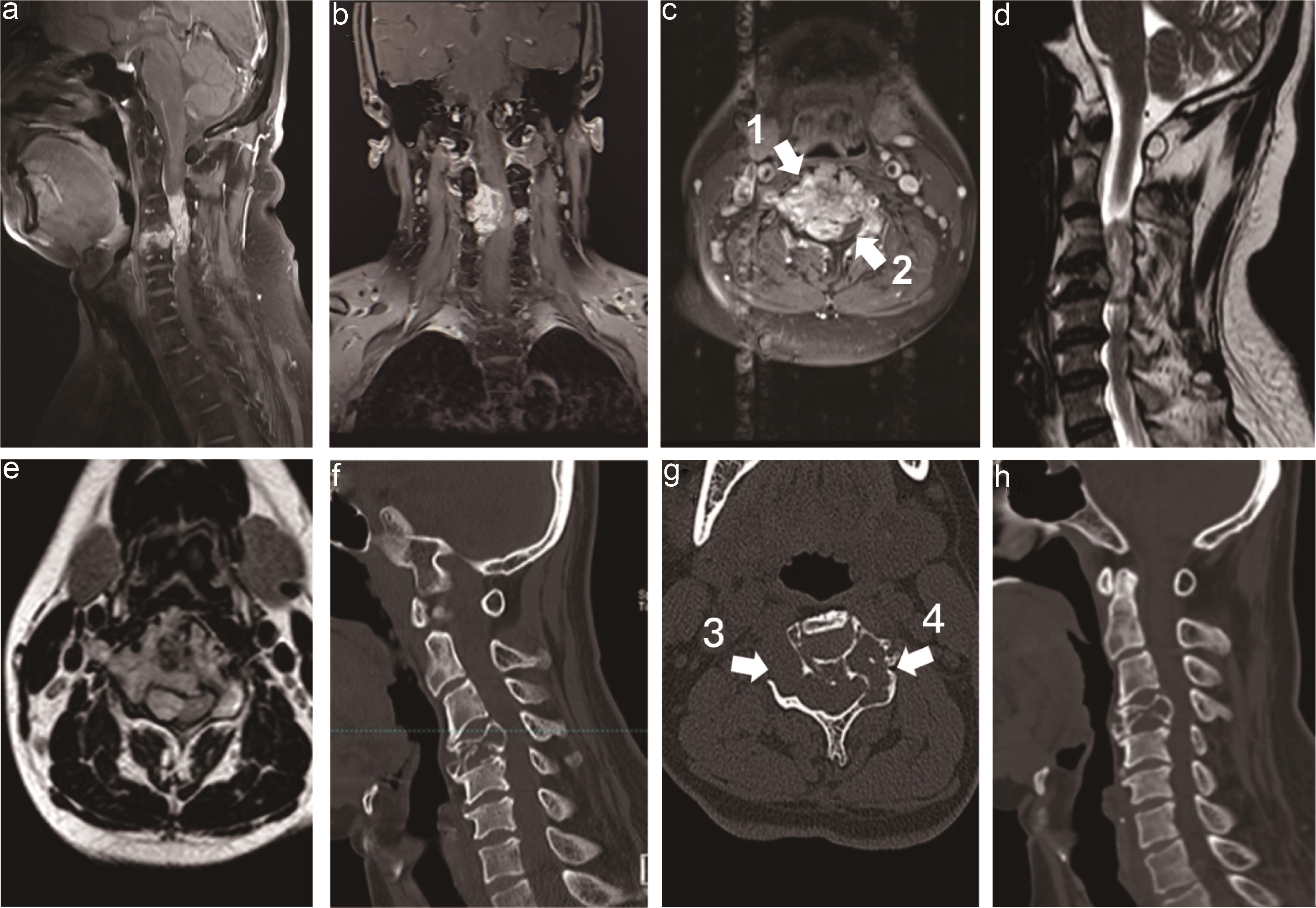 Preoperative cervical MRI and CT.