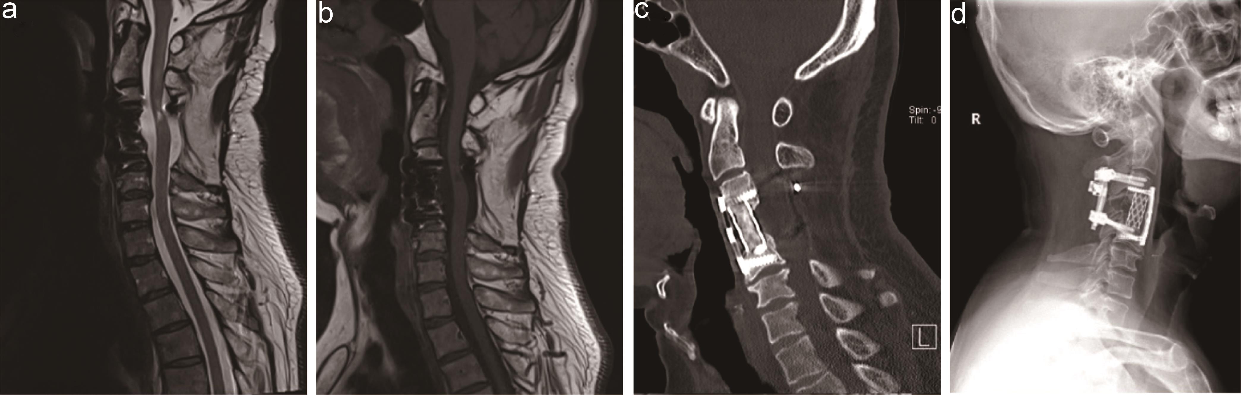 Follow-up MRI, CT, and X-ray 12 months after surgery.