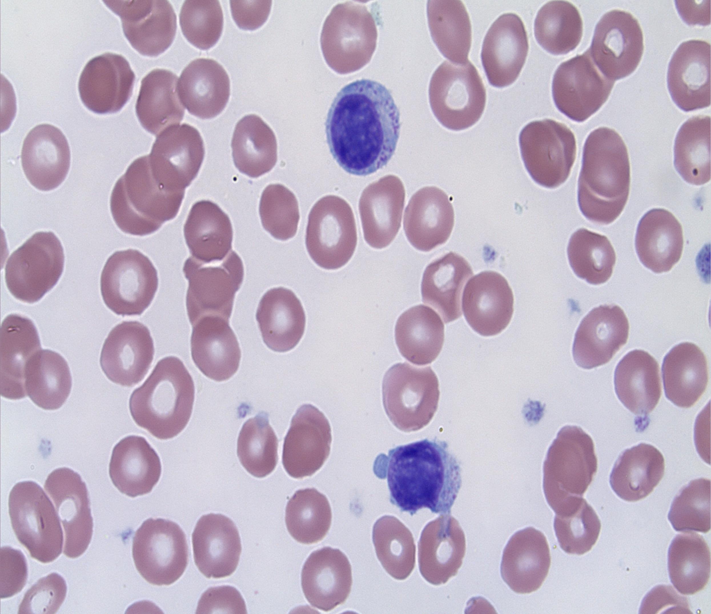 T-large granular lymphocytic leukemia (T-LGLL) lymphocytes with cytoplasmic azurophilic granules in peripheral blood (Wright-Giemsa stain, original magnification 100×).