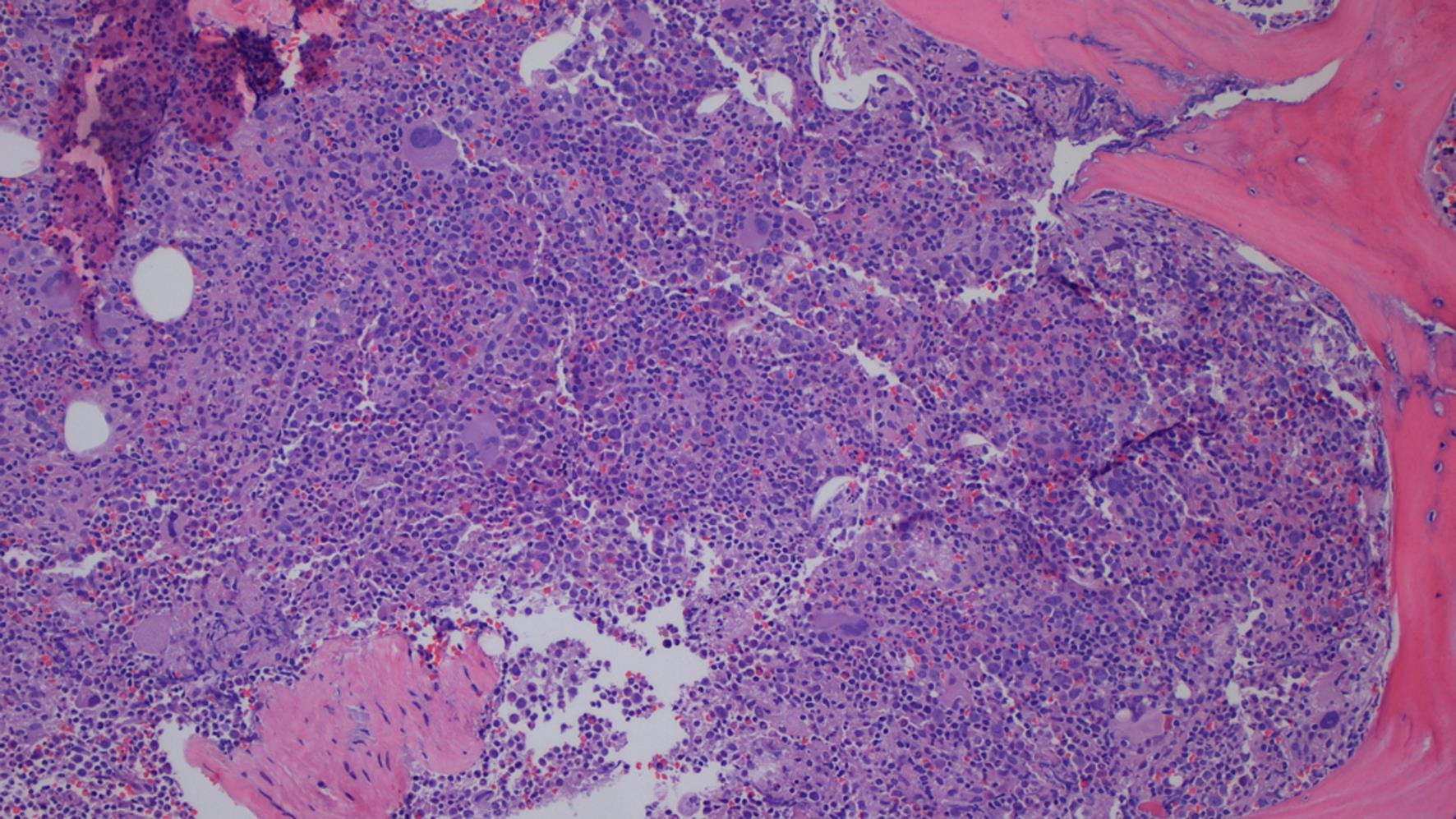 Hypercellular trephine core bone marrow biopsy with lymphoid infiltrate (Hematoxylin and Eosin stain, original magnification 100×).