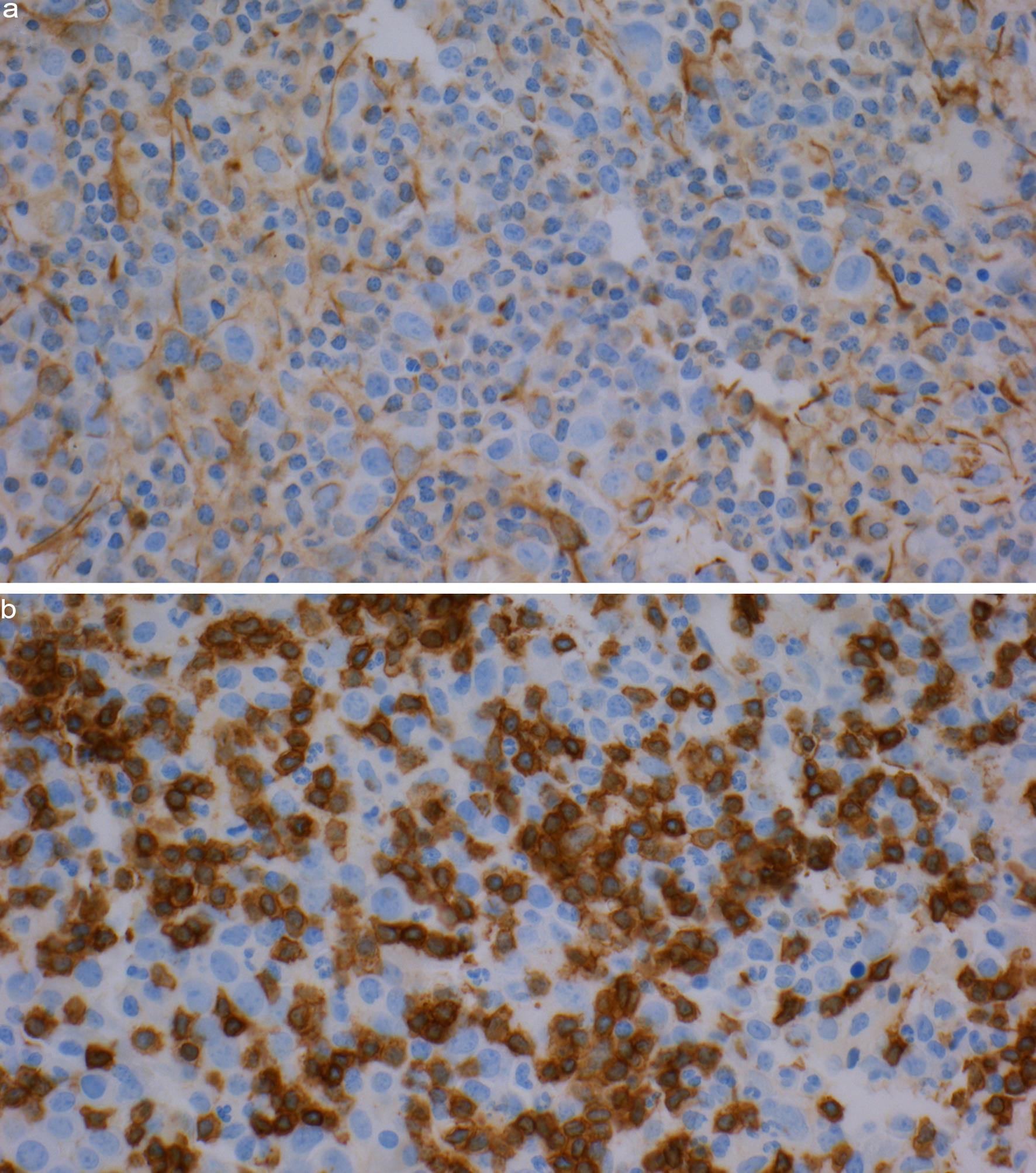 (a) Negative for PAX-5, a B-cell marker. (b) Positive for CD3 (Immunoperoxidase stain, original magnification 200×).