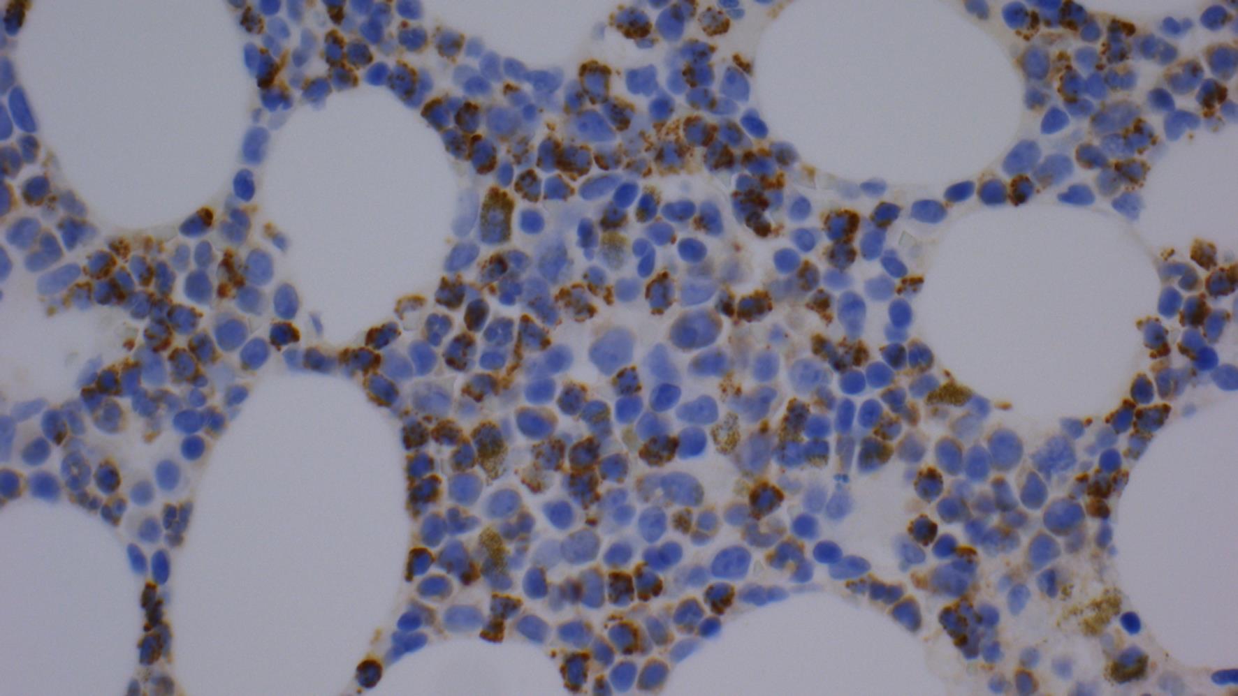 TIA-1 expression in T-large granular lymphocytic leukemia (T-LGLL) cells (Immunoperoxidase stain, original magnification 400×).